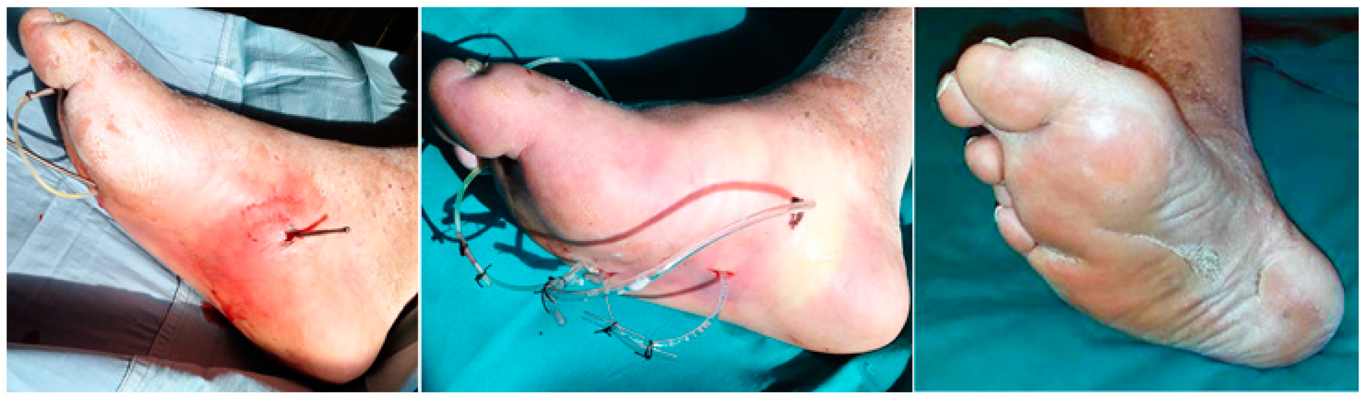 JCM | Free Full-Text | Diabetic Foot Infections: The Diagnostic Challenges
