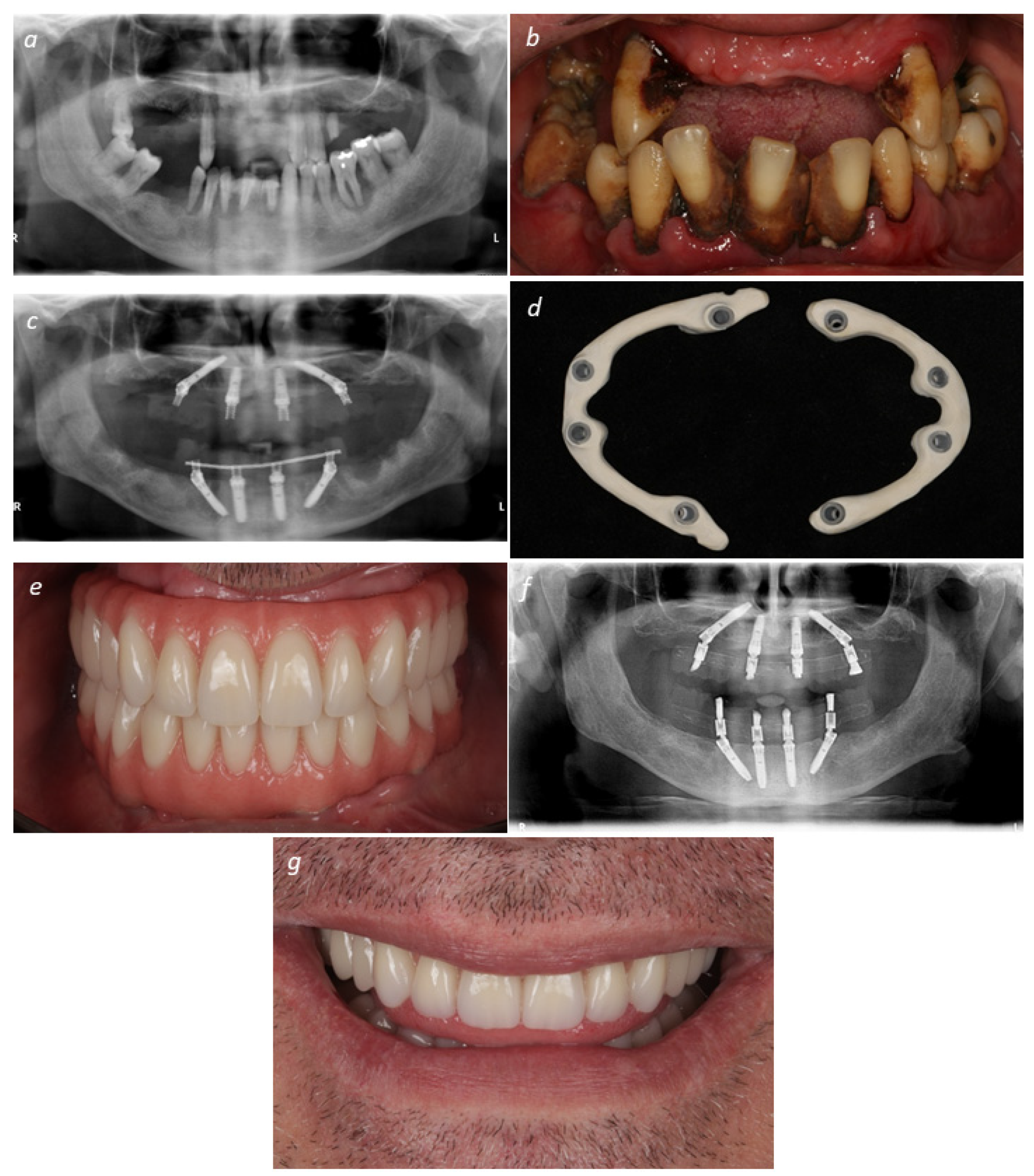 JCM | Free Full-Text | Hybrid Polyetheretherketone (PEEK)–Acrylic Resin  Prostheses and the All-on-4 Concept: A Full-Arch Implant-Supported Fixed  Solution with 3 Years of Follow-Up | HTML