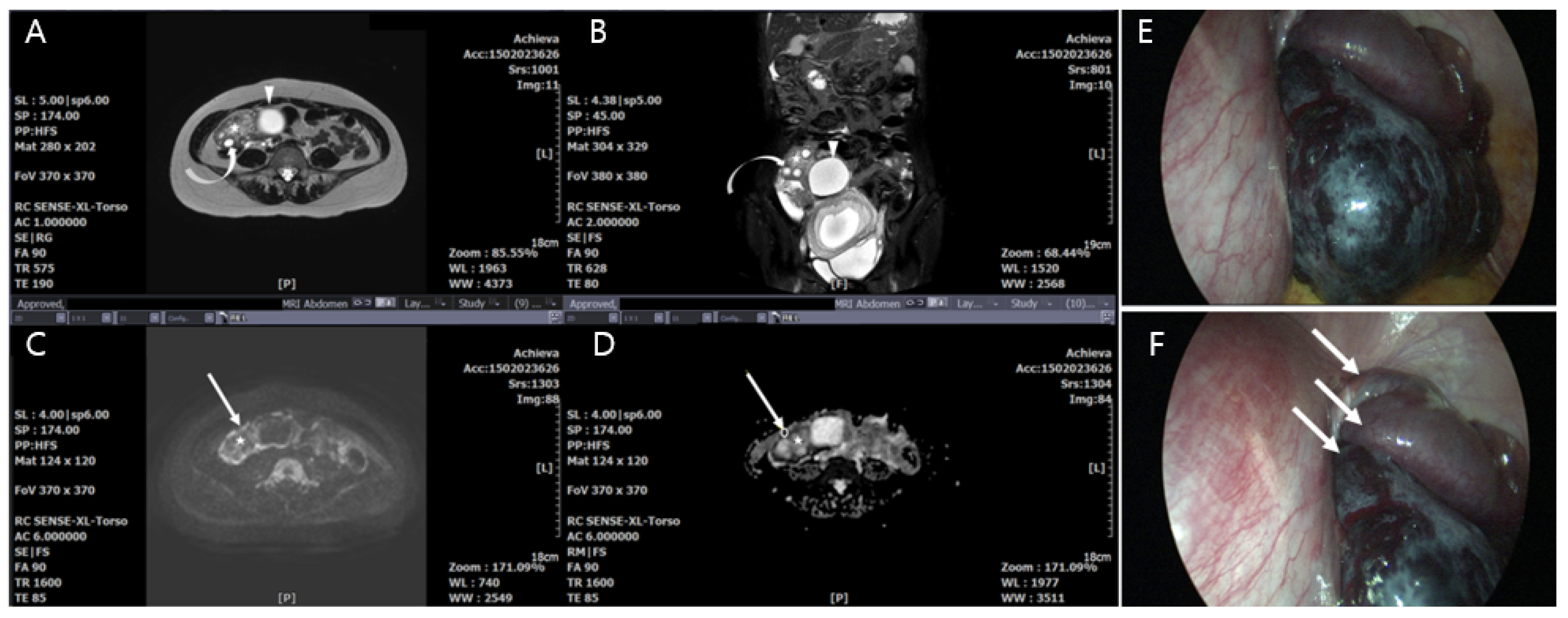 Torsion of paratubal cyst mimicking ovarian torsion: A rare case of  difficult diagnosis - ScienceDirect