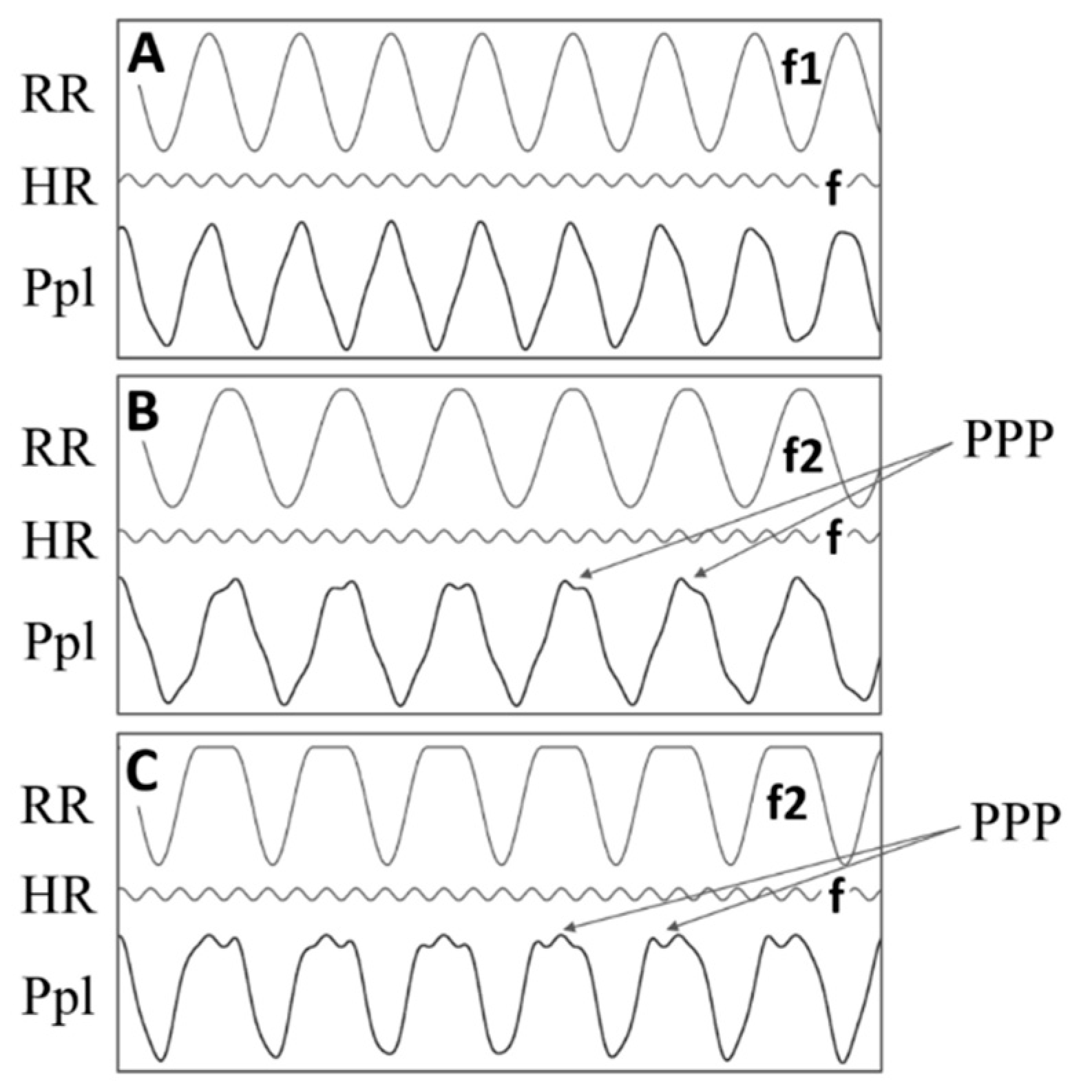 JCM | Free Full-Text | Pleural Pressure Pulse in Patients with Pleural ...