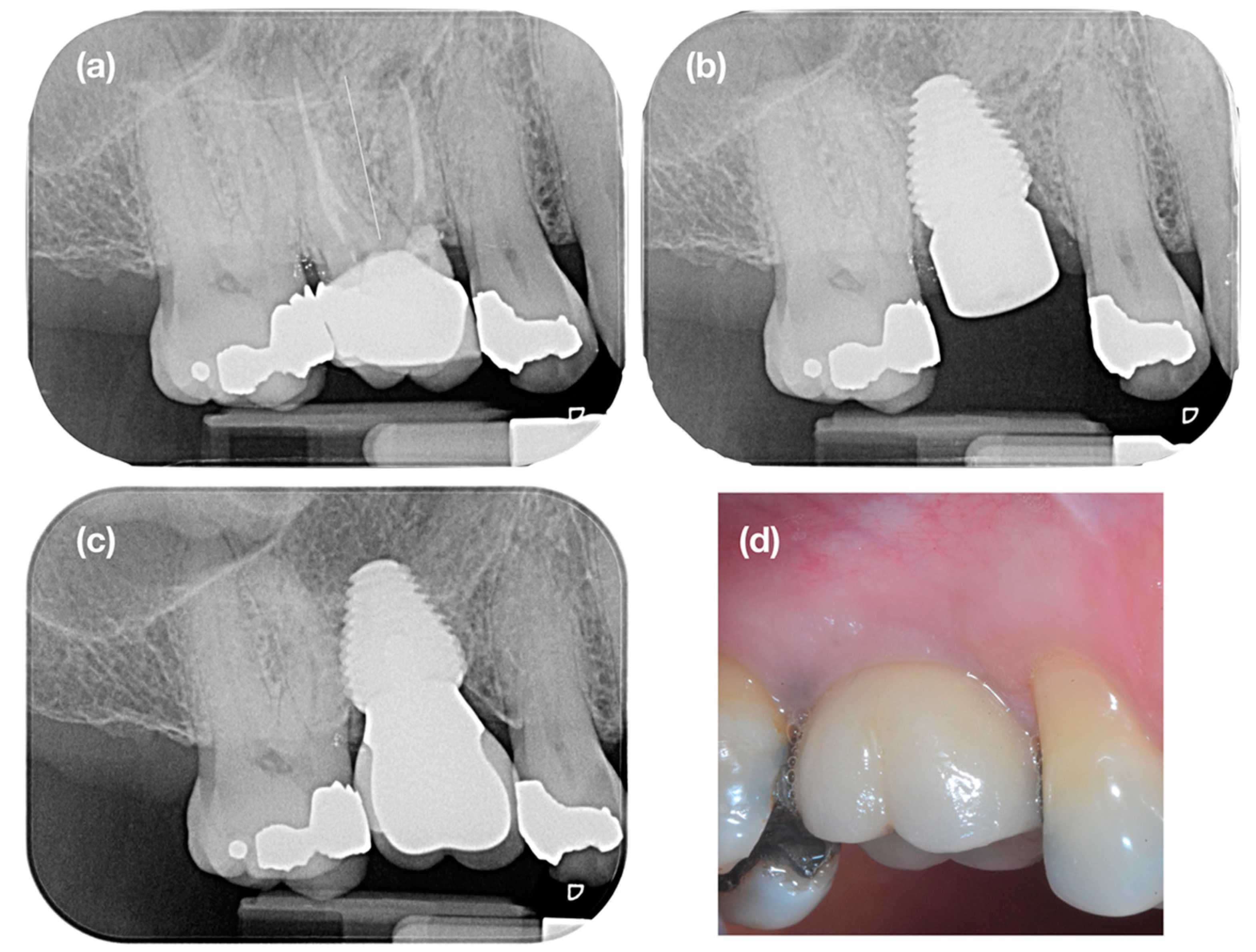 JCM  Free Full-Text  Contour Changes Following Immediate 