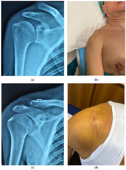 Arthroscopy Journal on X: The CC fixation method using multiple soft  anchor knots showed satisfactory results and had superior CC ligament  healing ability and maintenance of CC distance compared to hook fixation #