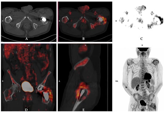 Jcm Free Full Text The Role Of Imaging Techniques To Define A Peri Prosthetic Hip And Knee 7473