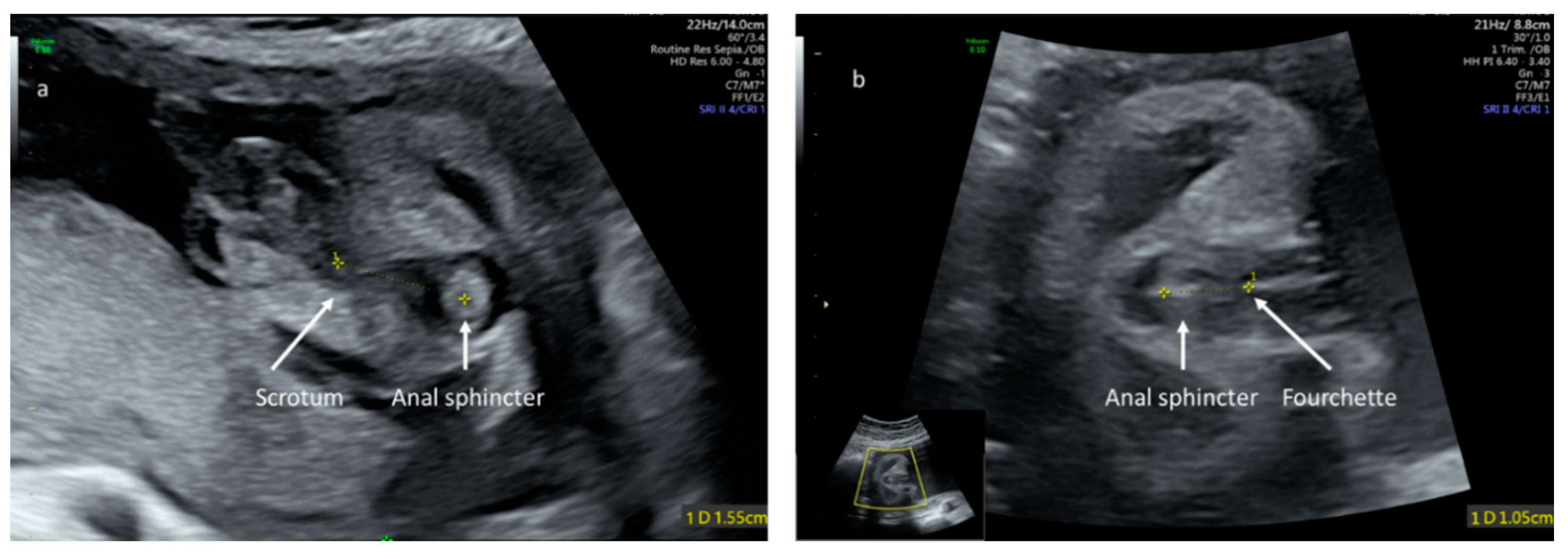 JCM | Free Full-Text | Foetal Sonographic Anogenital Distance Is Longer in  Polycystic Ovary Syndrome Mothers
