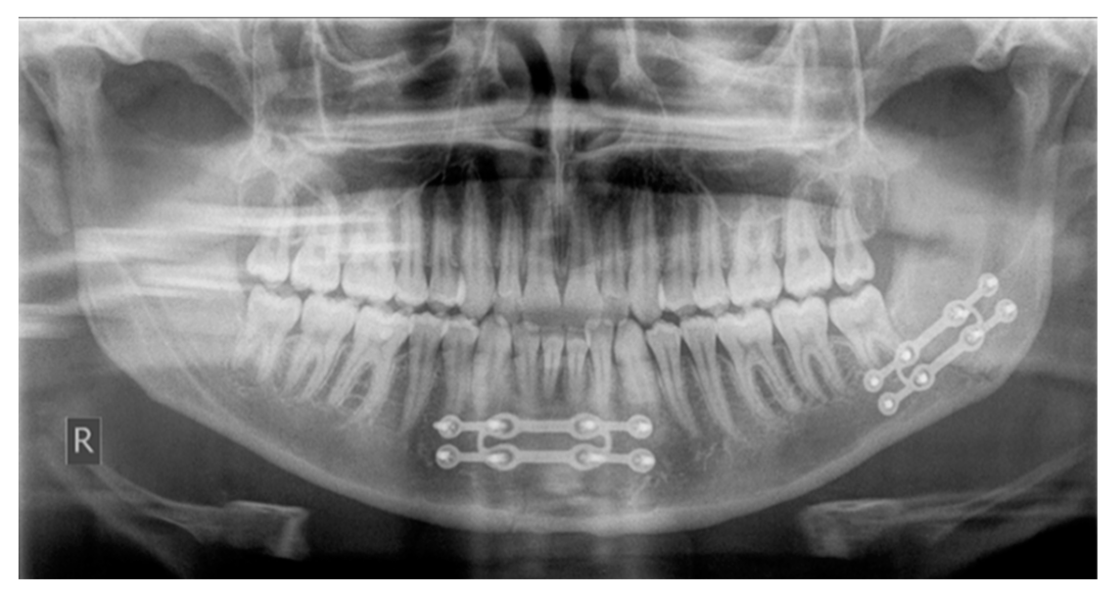 JCM | Free Full-Text | Treatment of Mandible Fractures Using a Miniplate  System: A Retrospective Analysis