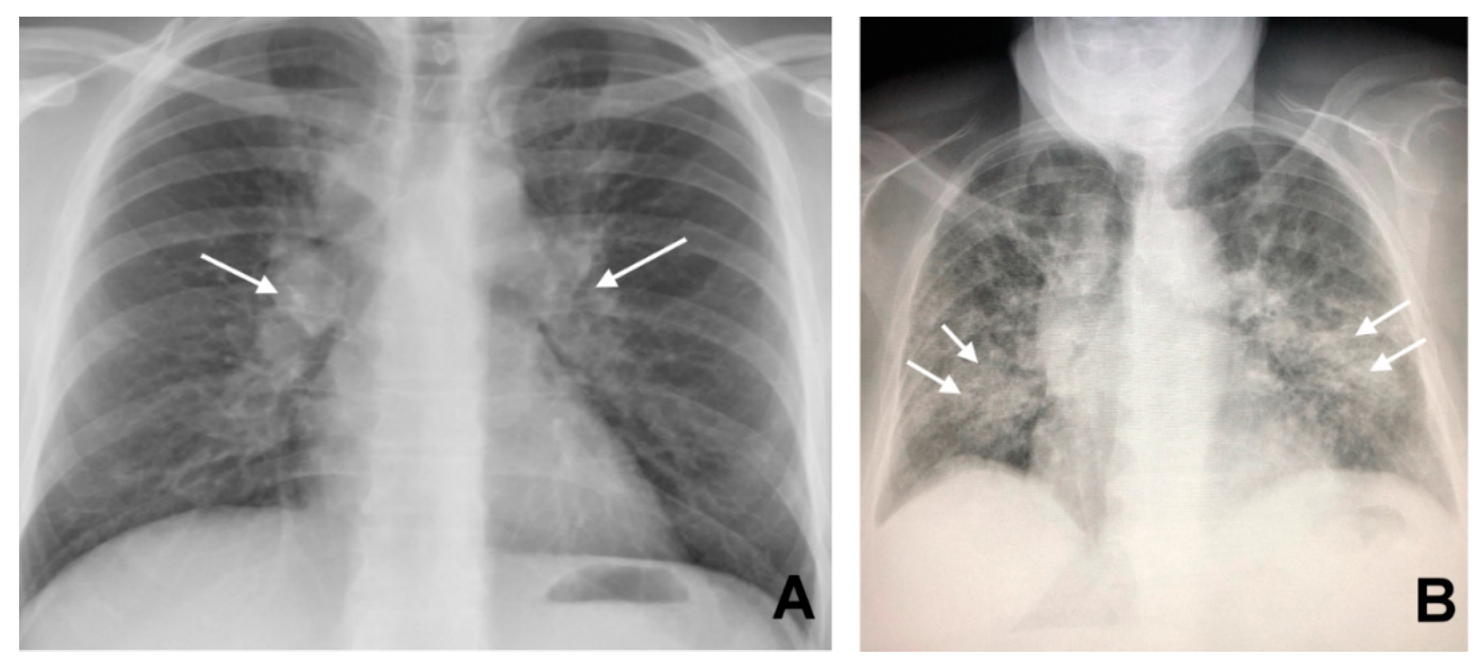 JCM | Free Full-Text | CT Findings in Pulmonary and Abdominal Sarcoidosis.  Implications for Diagnosis and Classification