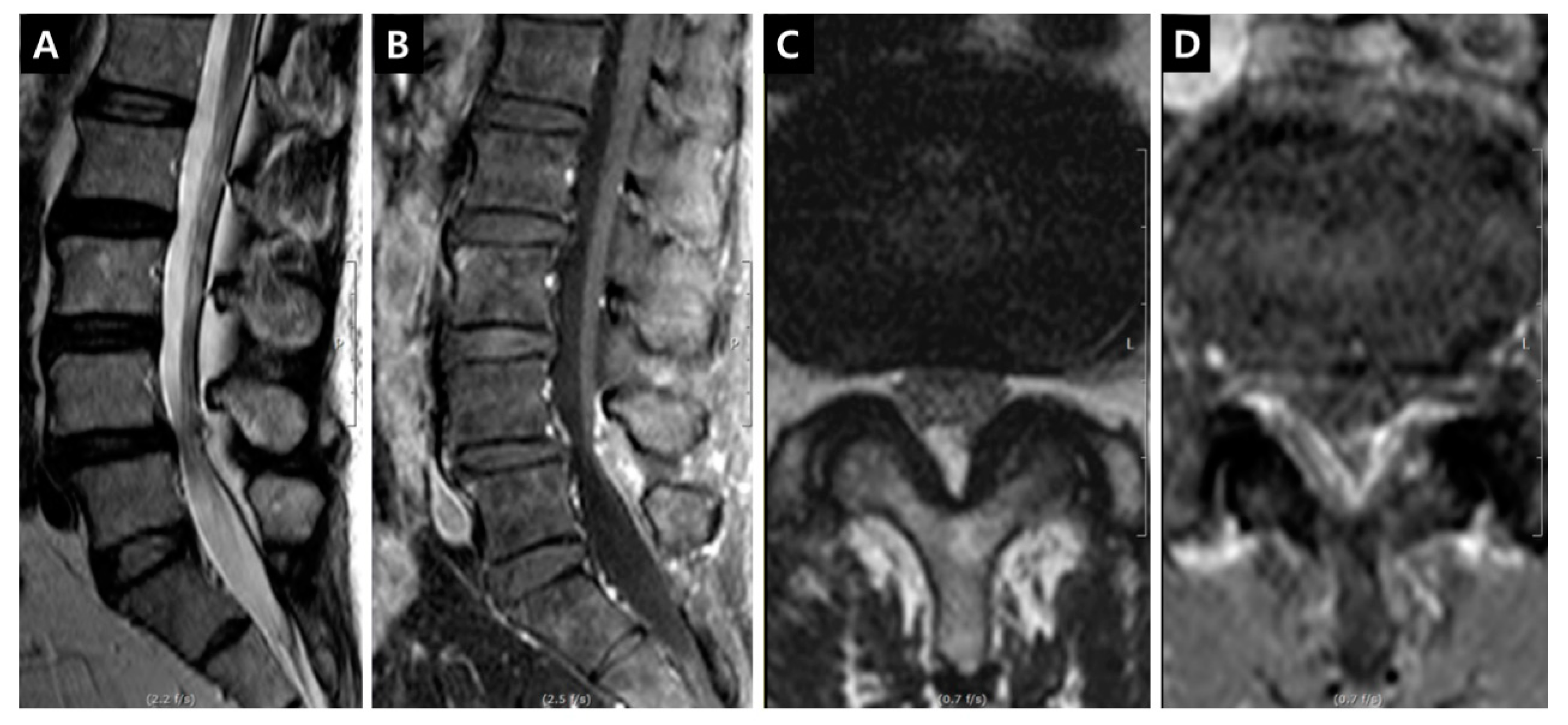 Magnetic resonance imaging scan of dorso-lumbar spine. T2 weighted