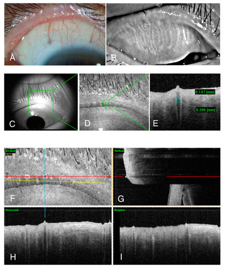 JCM | Free Full-Text | Comparison of the Meibomian Gland Openings by ...