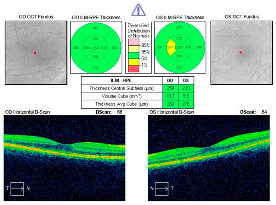 Jcm Free Full Text Short Term Presence Of Subretinal Fluid In Central Serous Chorioretinopathy Affects Retinal Thickness And Function