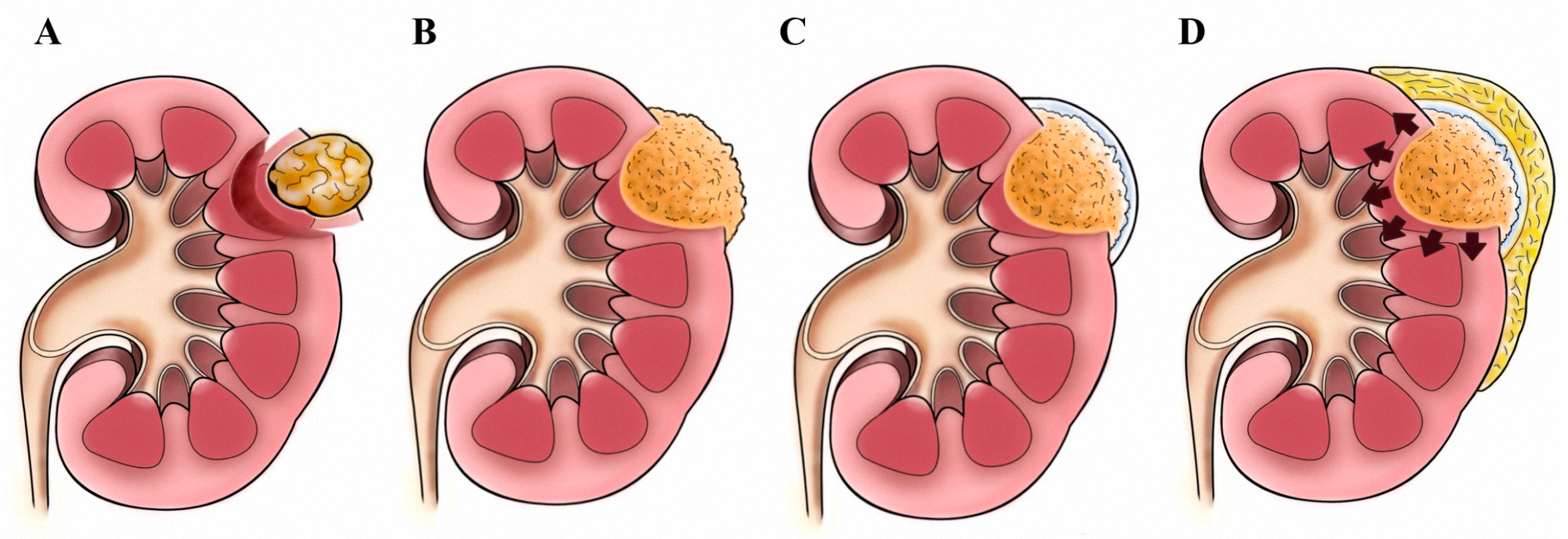 Jcm Free Full Text Single Site Sutureless Partial Nephrectomy For Small Exophytic Renal Tumors Html