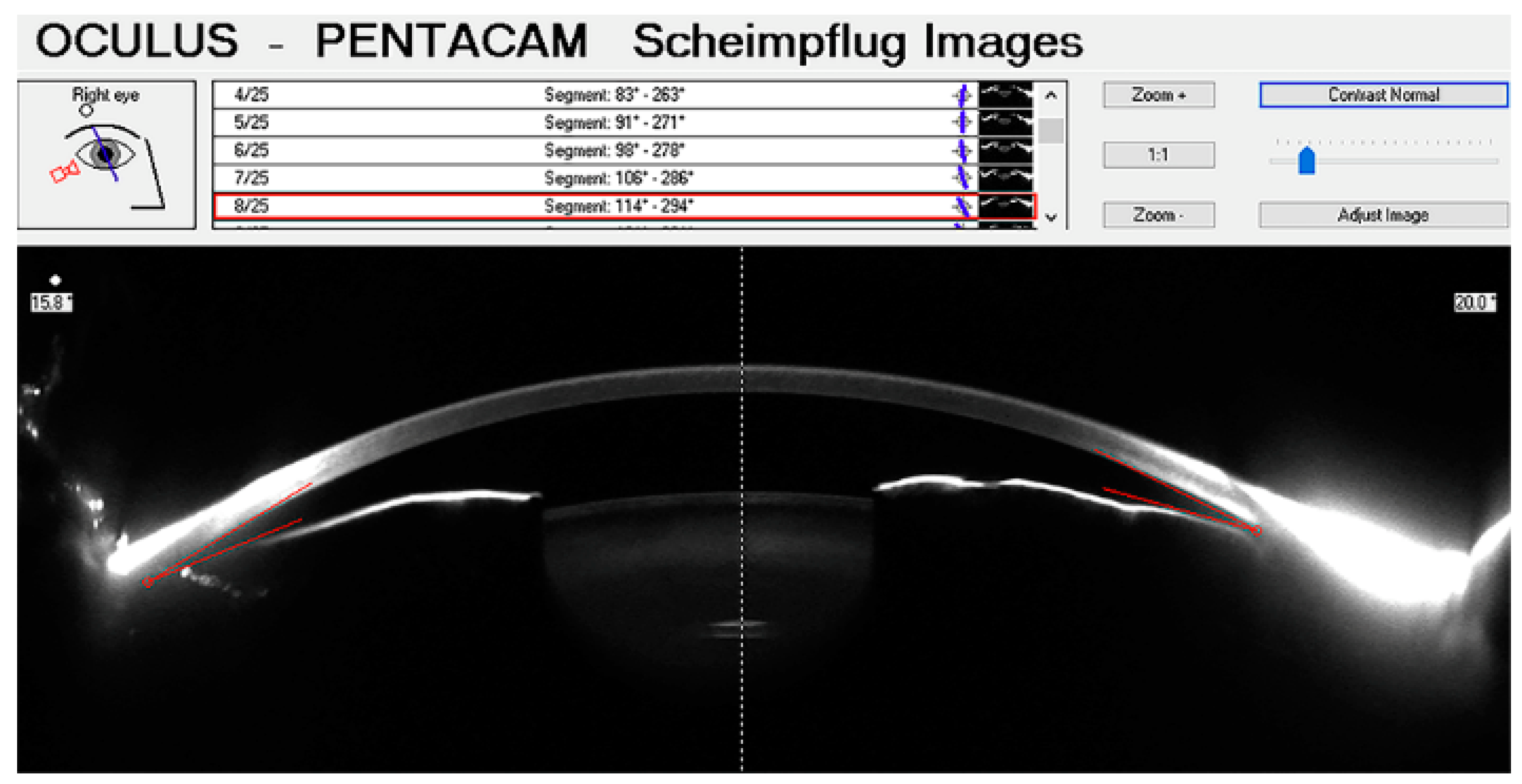 JCM | Free Full-Text | Anterior Chamber Angle Assessment Techniques: A  Review | HTML
