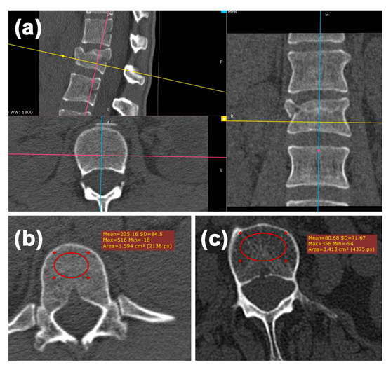 JCM Free Full Text Differentiation of Traumatic Osteoporotic