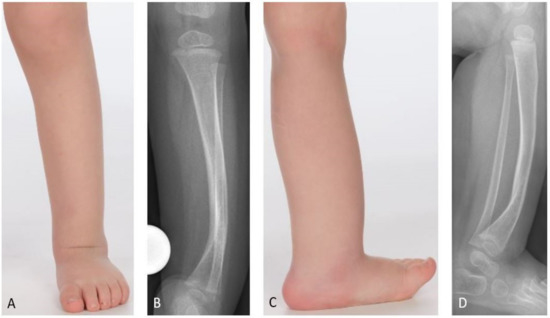 An unusual form of congenital anterolateral tibial angulation—the delta  tibia