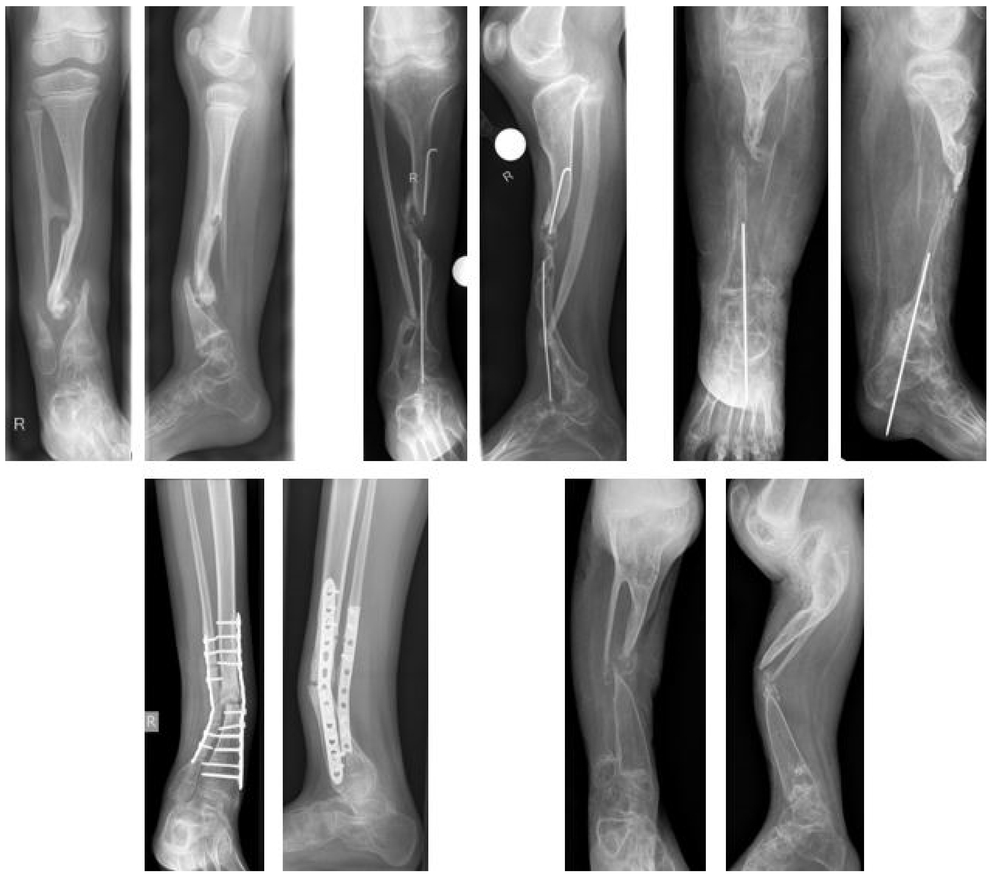 Cureus, Congenital Pseudoarthrosis of Tibia With Anterolateral Bowing  Treated With Ilizarov Ring Fixator: A Case Report