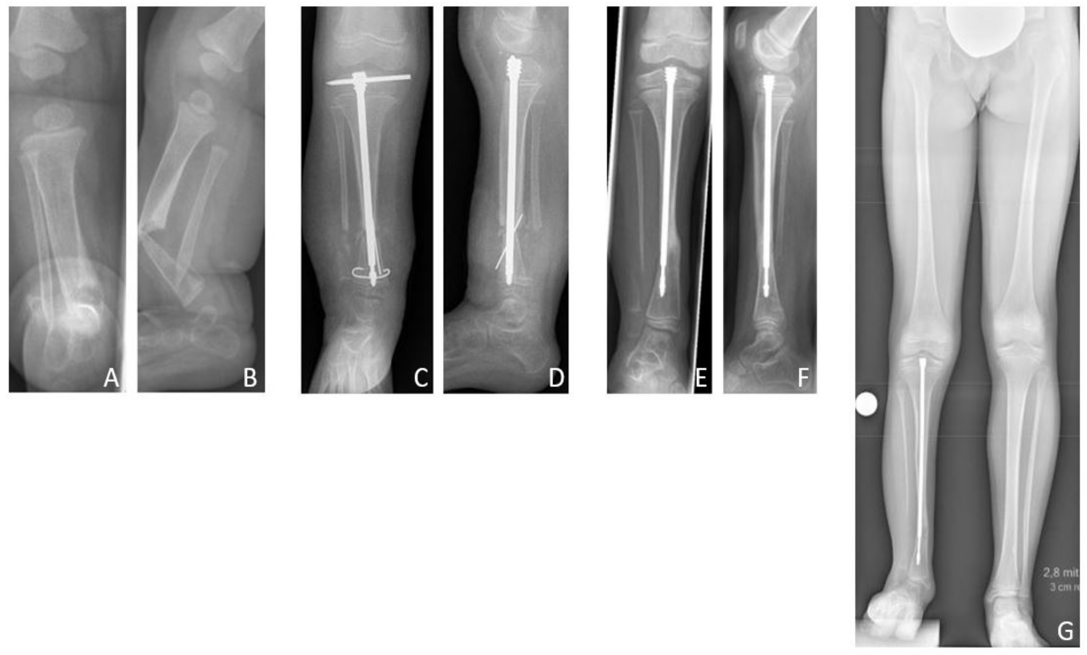 cpt code intramedullary nail intertrochanteric fracture
