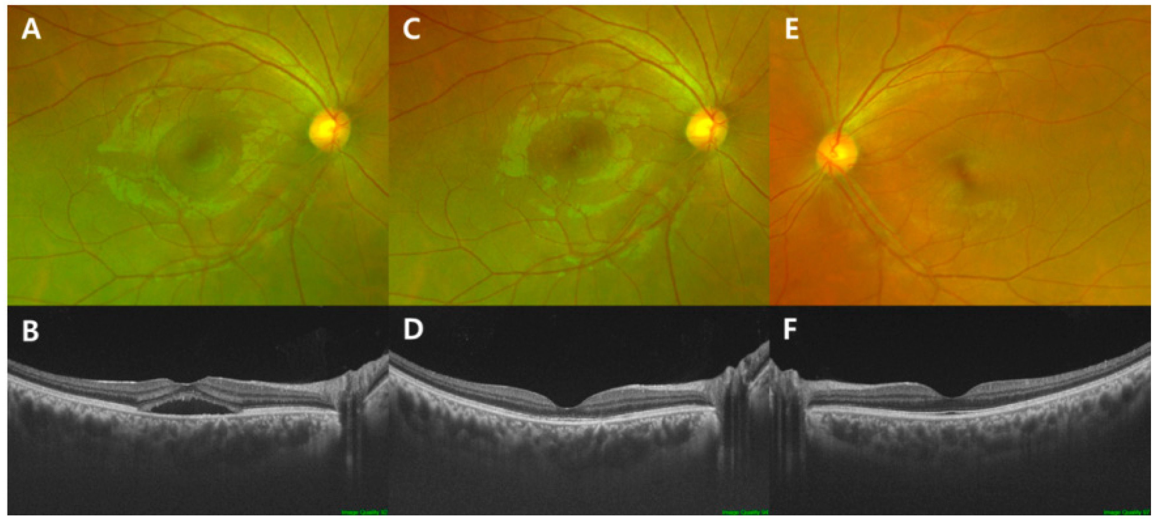 serous retinal detachment oct