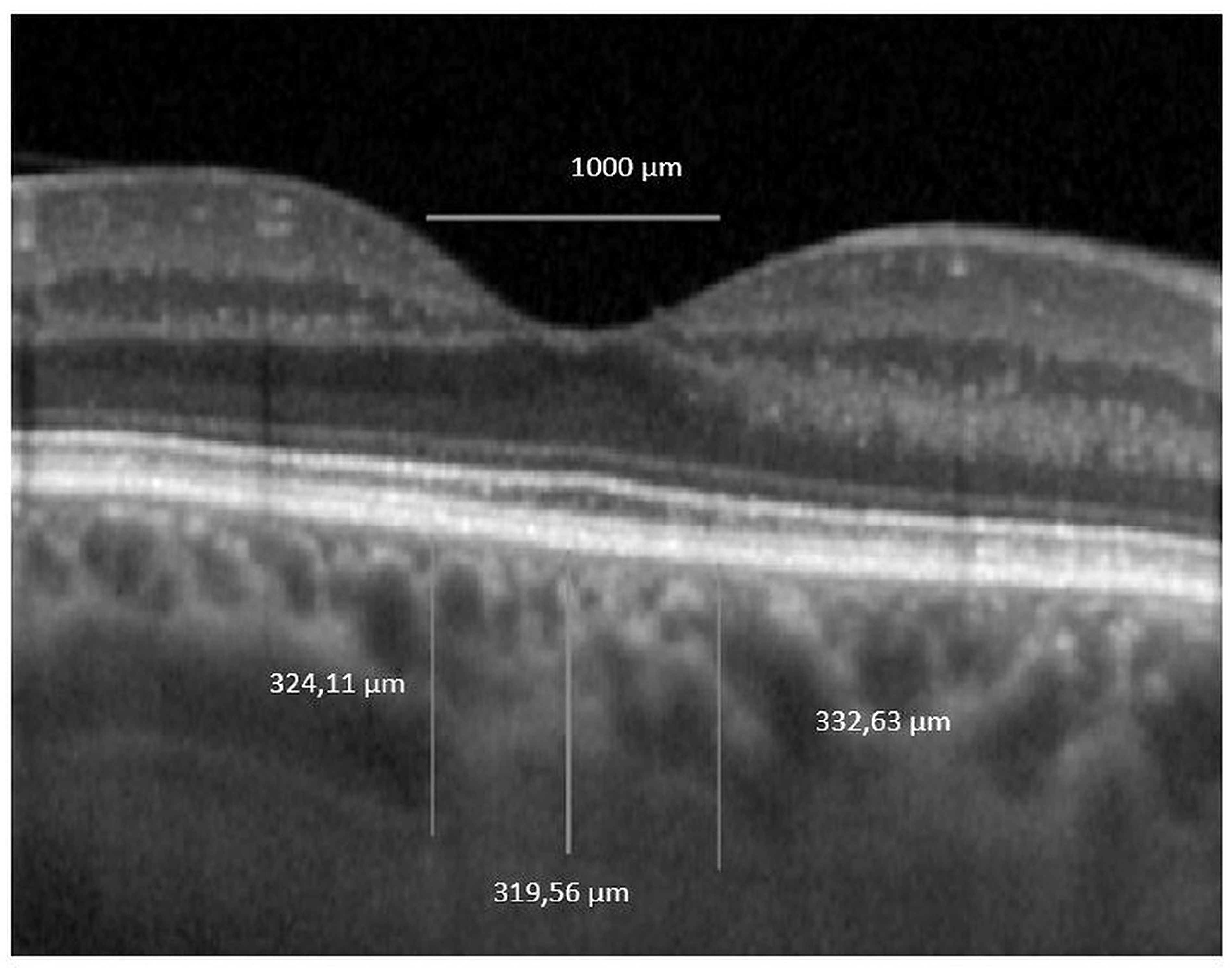 Jcm Free Full Text Analysis Of The Choroid And Its Relationship With The Outer Retina In Patients With Diabetes Mellitus Using Binarization Techniques Based On Spectral Domain Optical Coherence Tomography Html