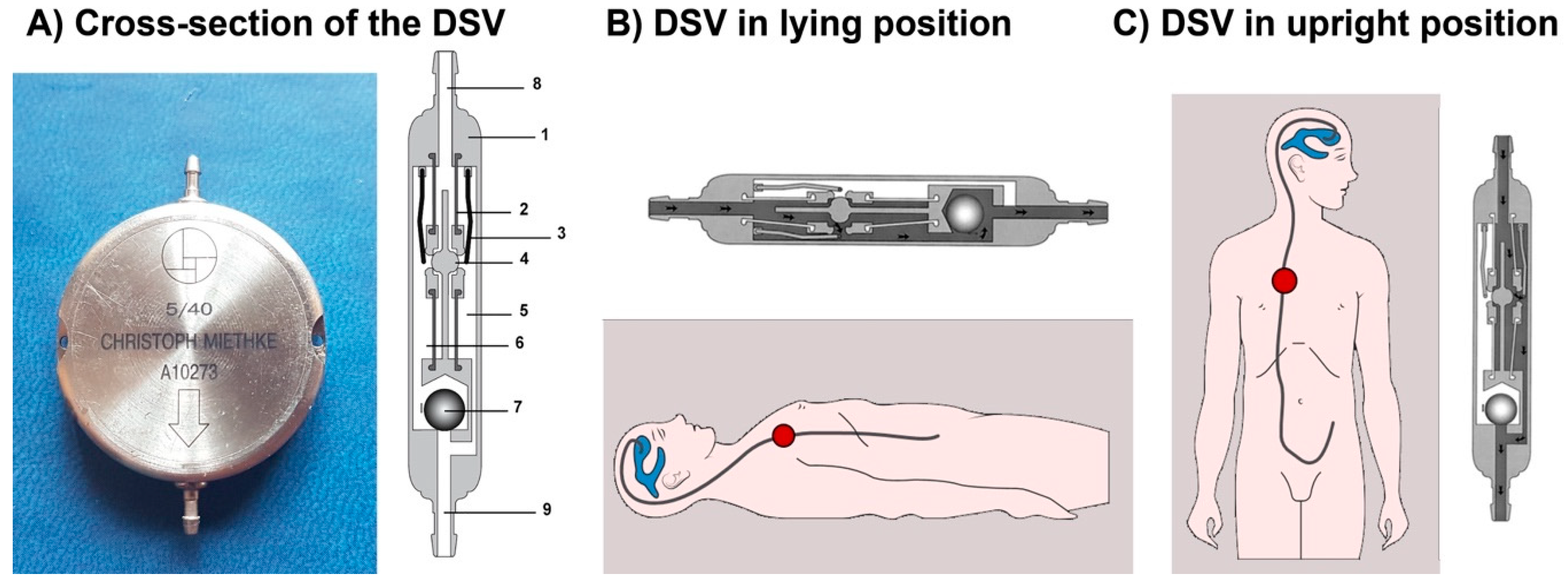JCM | Free Full-Text | Considerations in the Use of Gravitational Valves in  the Management of Hydrocephalus. Some Lessons Learned with the Dual-Switch  Valve