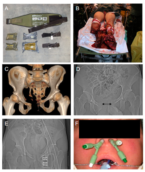 Jcm Free Full Text The European Perspective On The Management Of Acute Major Hemorrhage And Coagulopathy After Trauma Summary Of The 2019 Updated European Guideline Html