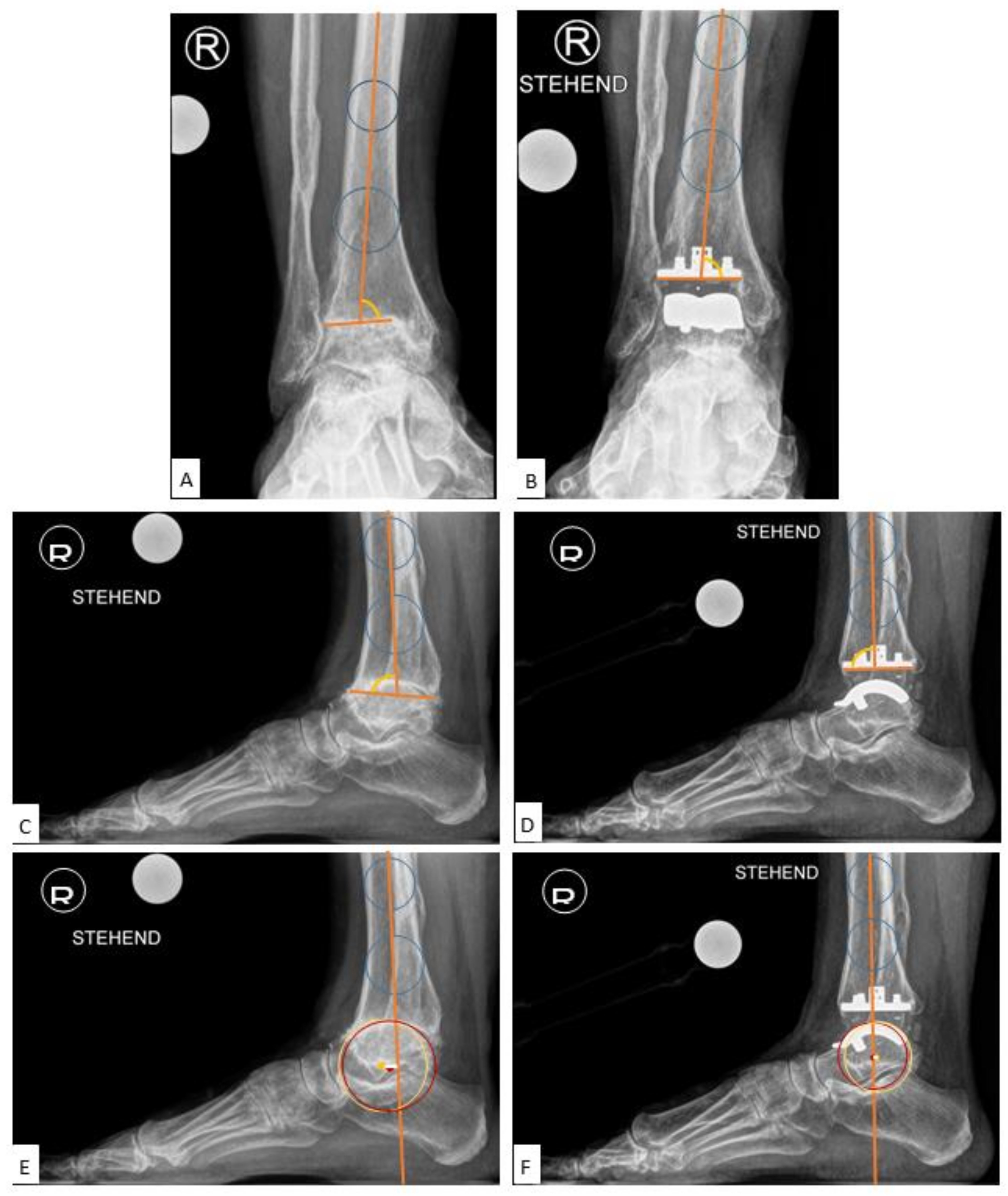 Extra-Caliber (carbon fiber) Radiolucent Tibia/Ankle System