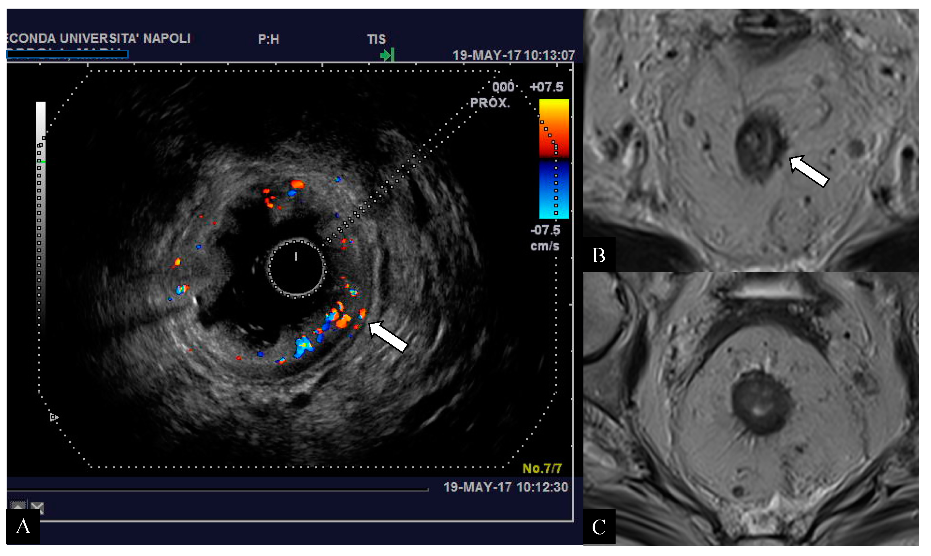 JCM Free FullText Endorectal Ultrasound and Resonance