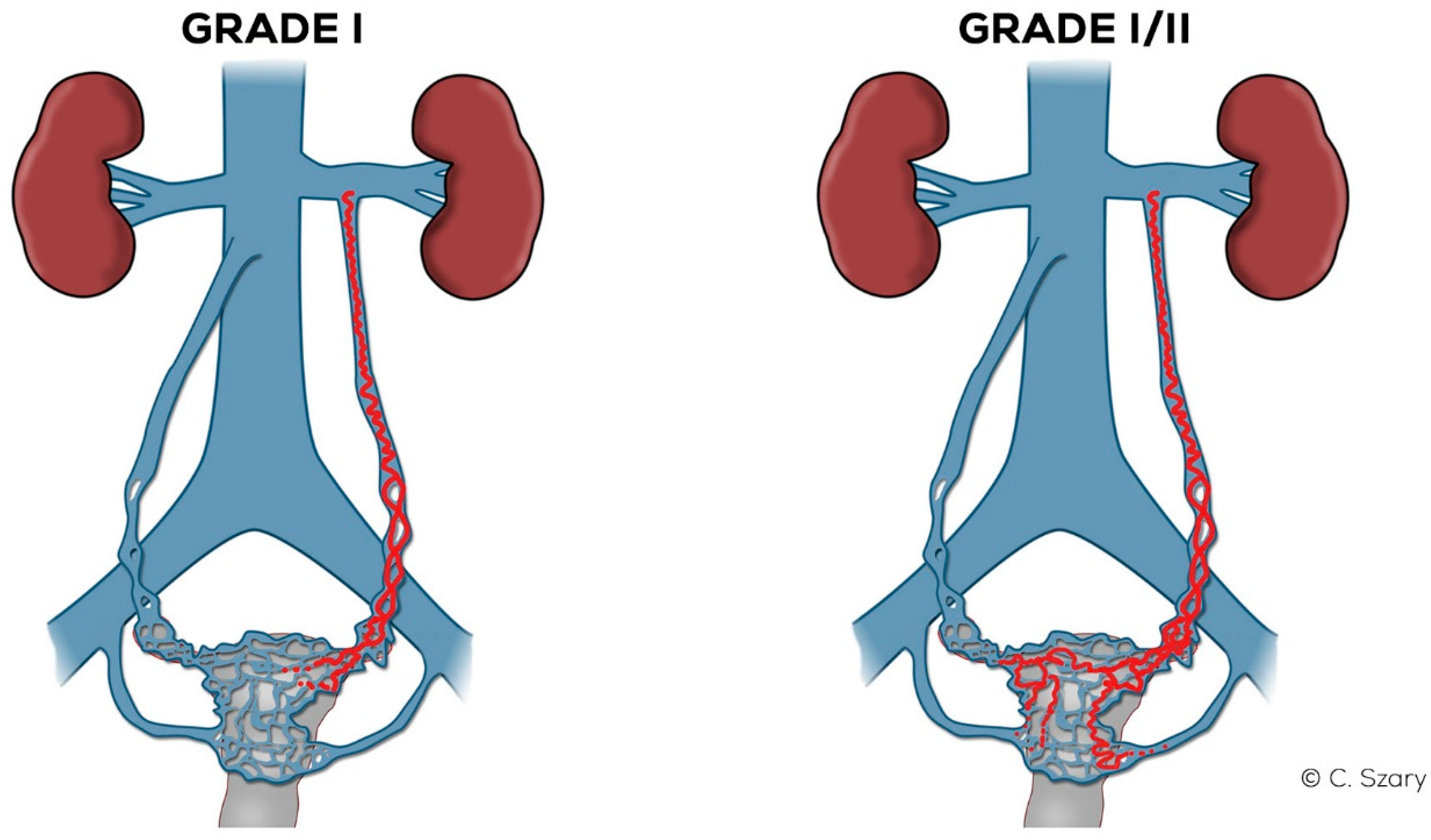 Jcm Free Full Text Hemodynamic And Radiological Classification Of Ovarian Veins System Insufficiency Html