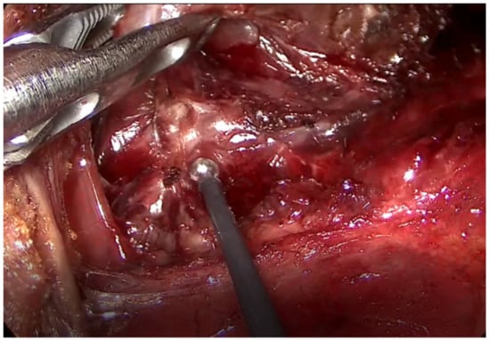 What You Need to Know about Mental Nerve Surgical Anatomy for Transoral  Thyroidectomy