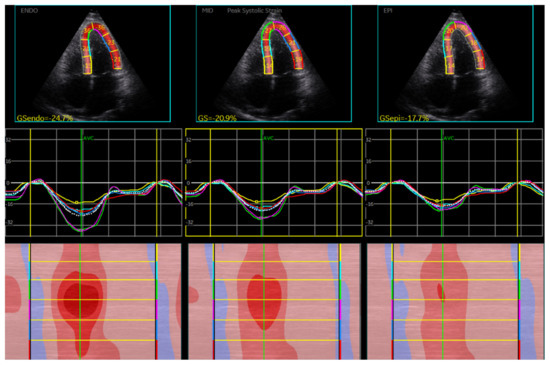 Highlighting the role of global longitudinal strain assessment in valvular  heart disease, The Egyptian Heart Journal