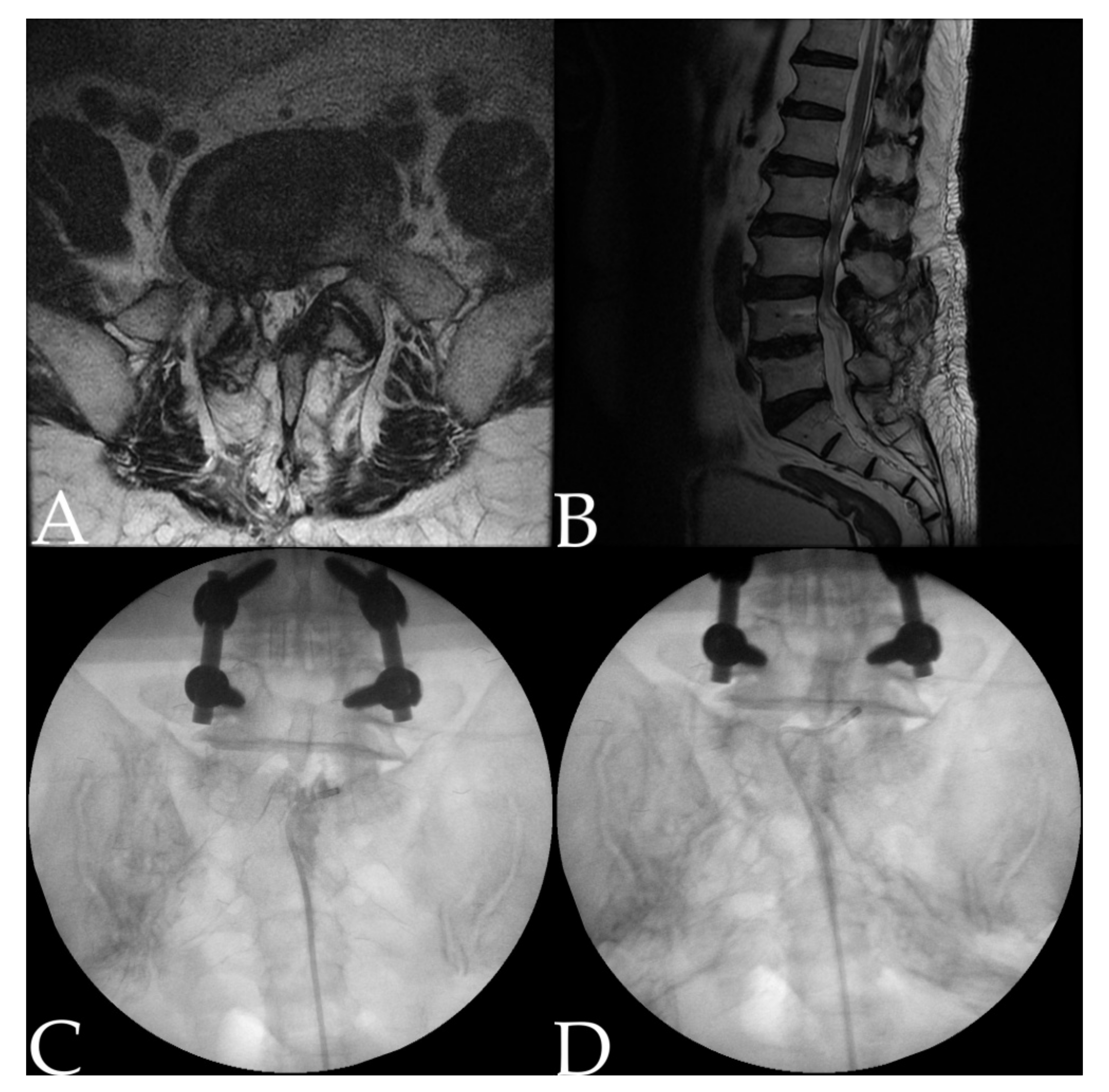 Spinal Stenosis: Symptoms & Causes (part 1): Pain Care, LLC: Interventional  Spine & Pain Management