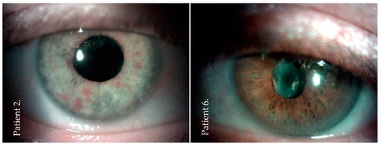 JCM | Free Full-Text | Urgent Vitrectomy with Vancomycin Infusion