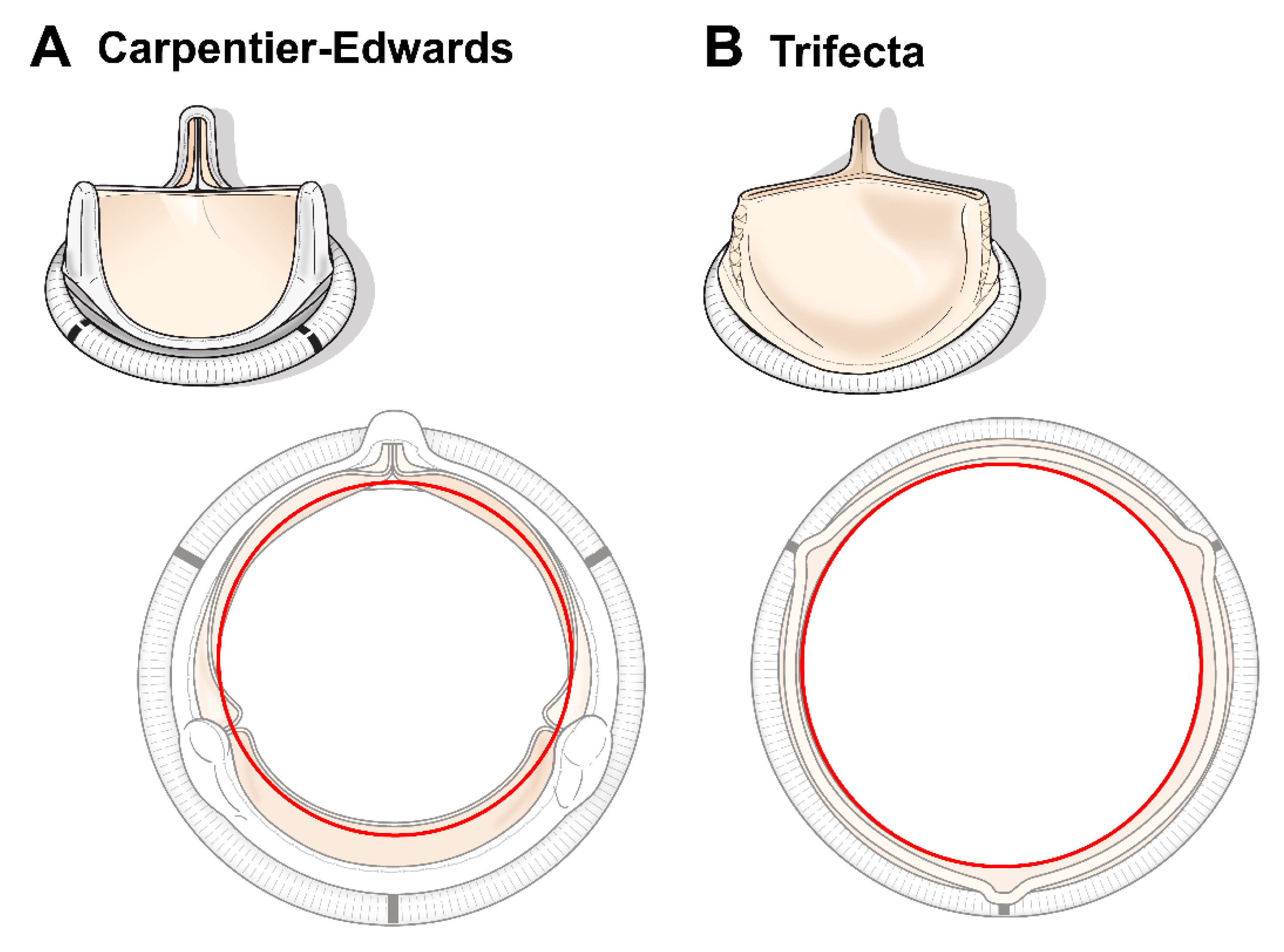 JCM | Free Full-Text | A Retrospective Comparison of Hemodynamic and  Clinical Outcomes between Two Differently Designed Aortic Bioprostheses for  Small Aortic Annuli
