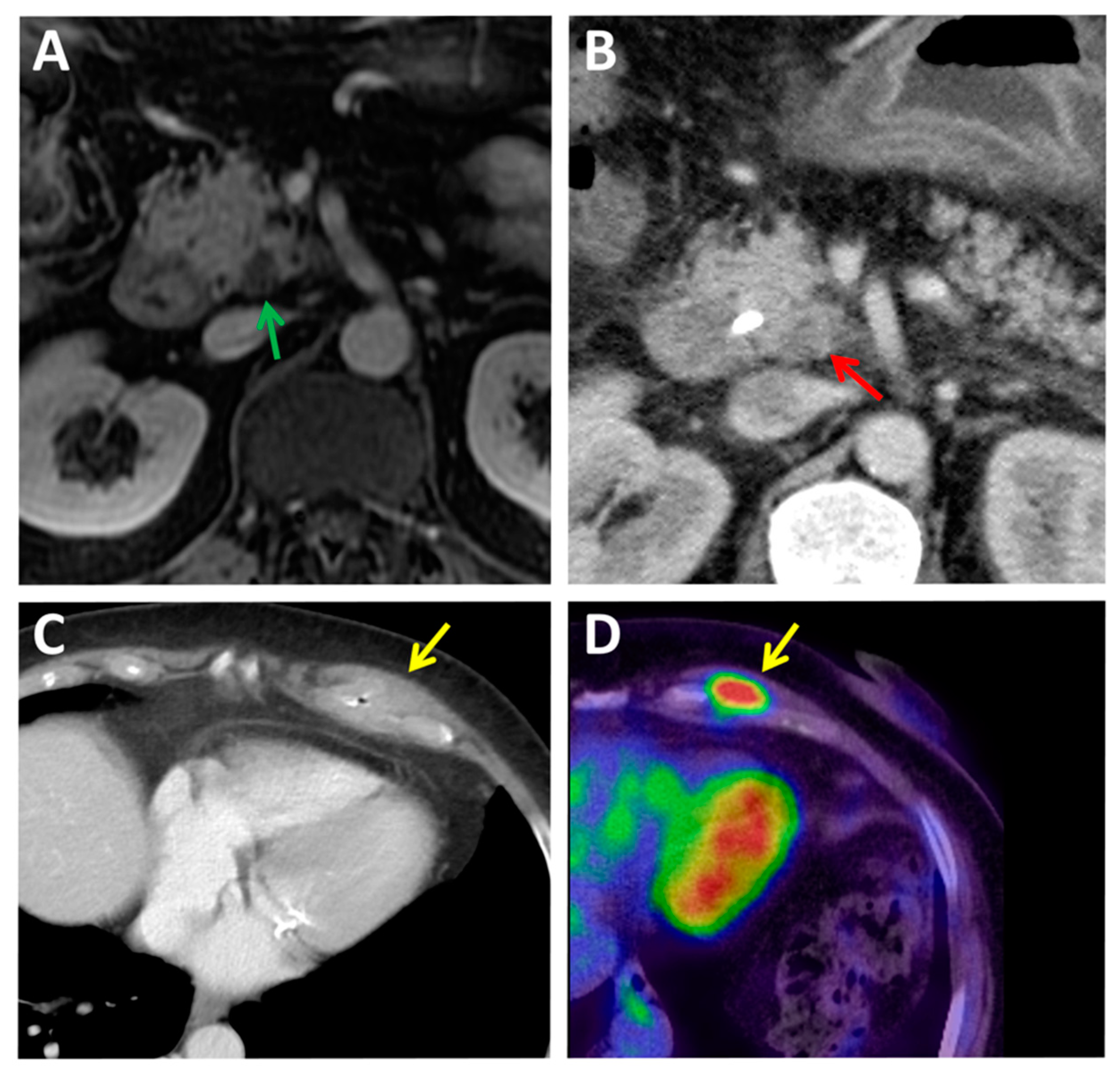 JCM | Free Full-Text | Diagnosis of Pancreatic Ductal Adenocarcinoma by  Immuno-Positron Emission Tomography