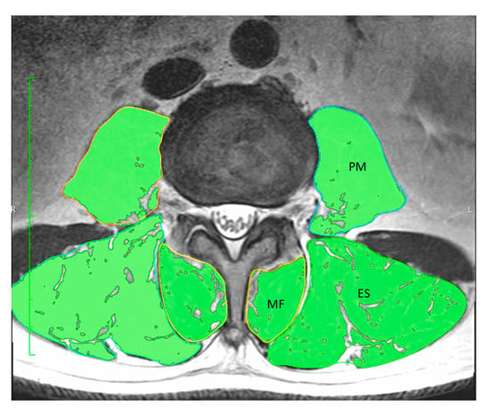 Association between trunk muscle mass and log for visual analog scale