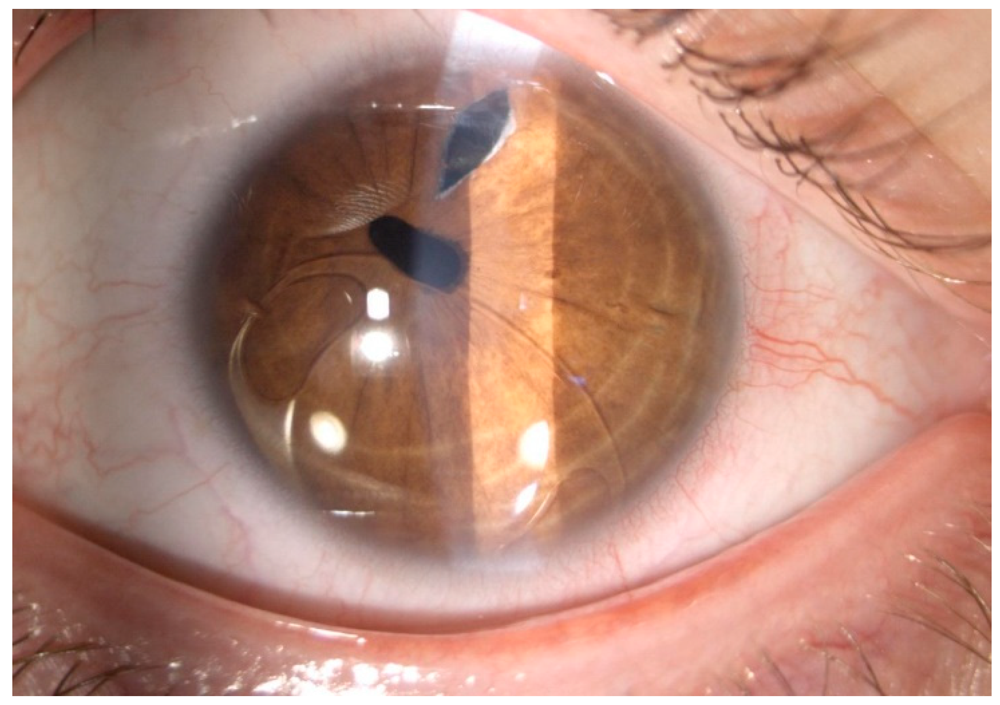JCM | Free Full-Text | Iris-Claw Intraocular Lens Implantation in Various  Clinical Indications: A 4-Year Study
