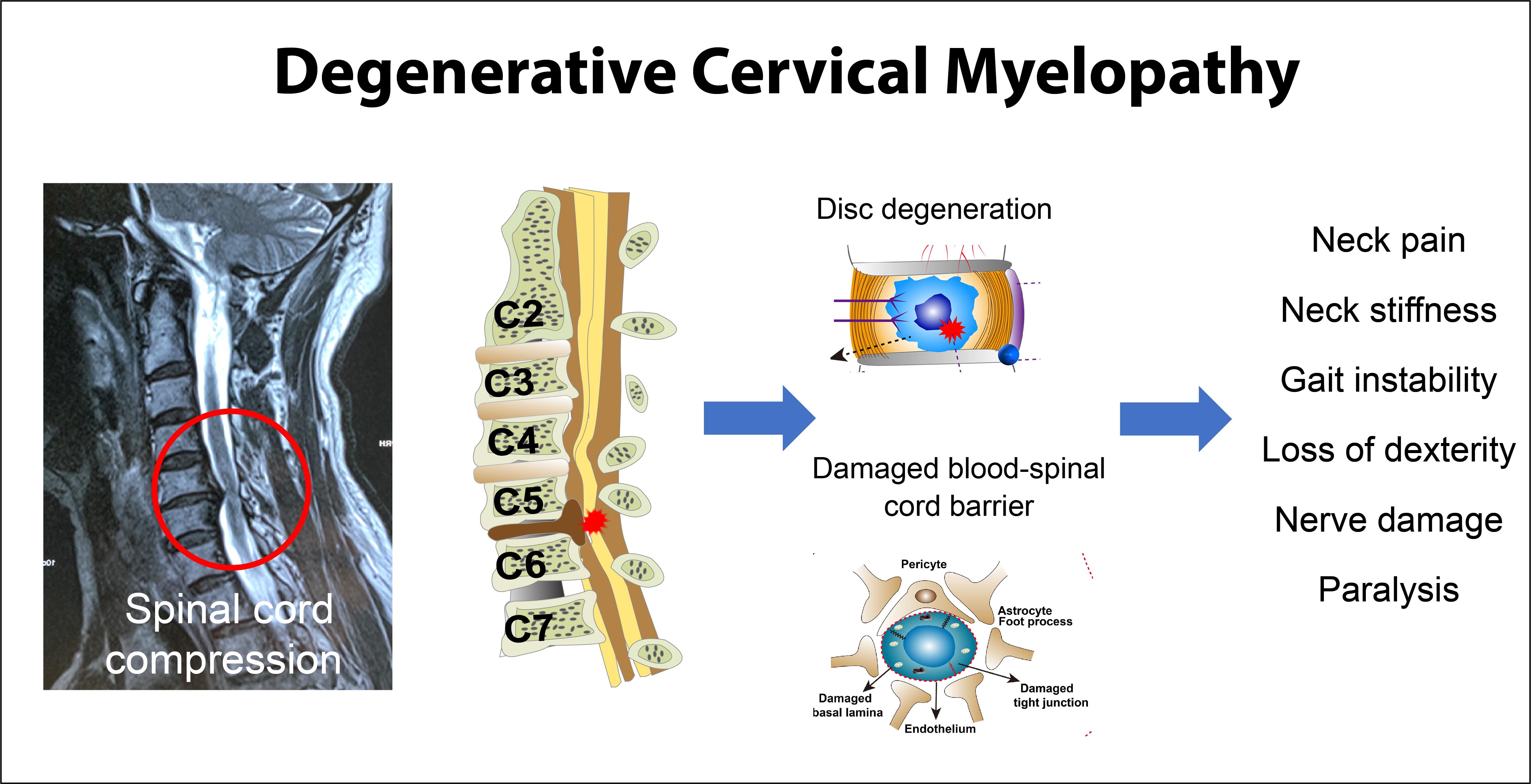 Jcm Free Full Text Degenerative Cervical Myelopathy Insights Into Its Pathobiology And Molecular Mechanisms Html