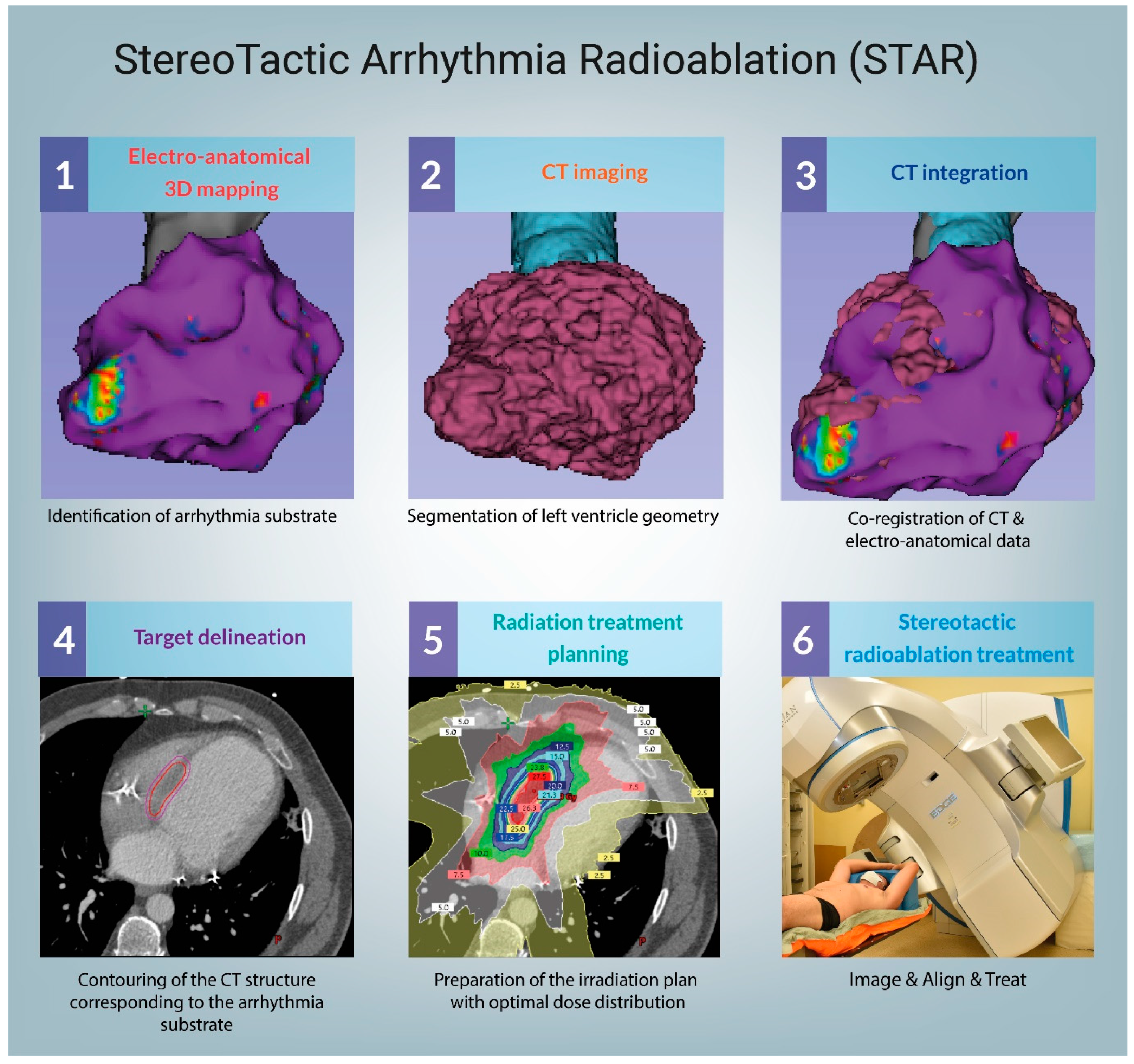 JCM | Free Full-Text | Clinical Evidence behind Stereotactic Radiotherapy  for the Treatment of Ventricular Tachycardia (STAR)—A Comprehensive Review  | HTML