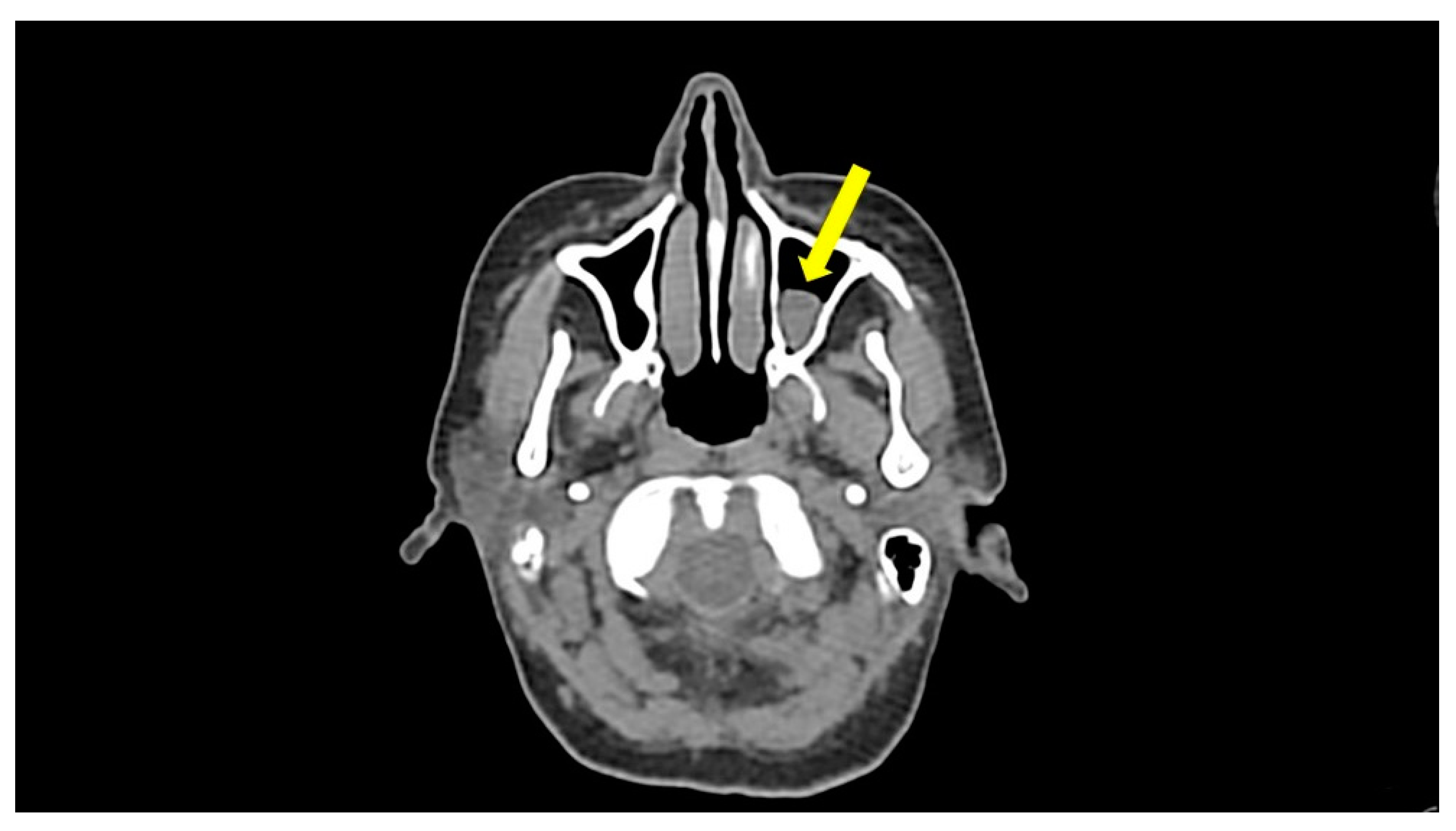 JCM | Free Full-Text | Episodic Angioedema with Hypereosinophilia (Gleich's  Syndrome): A Case Report and Extensive Review of the Literature | HTML