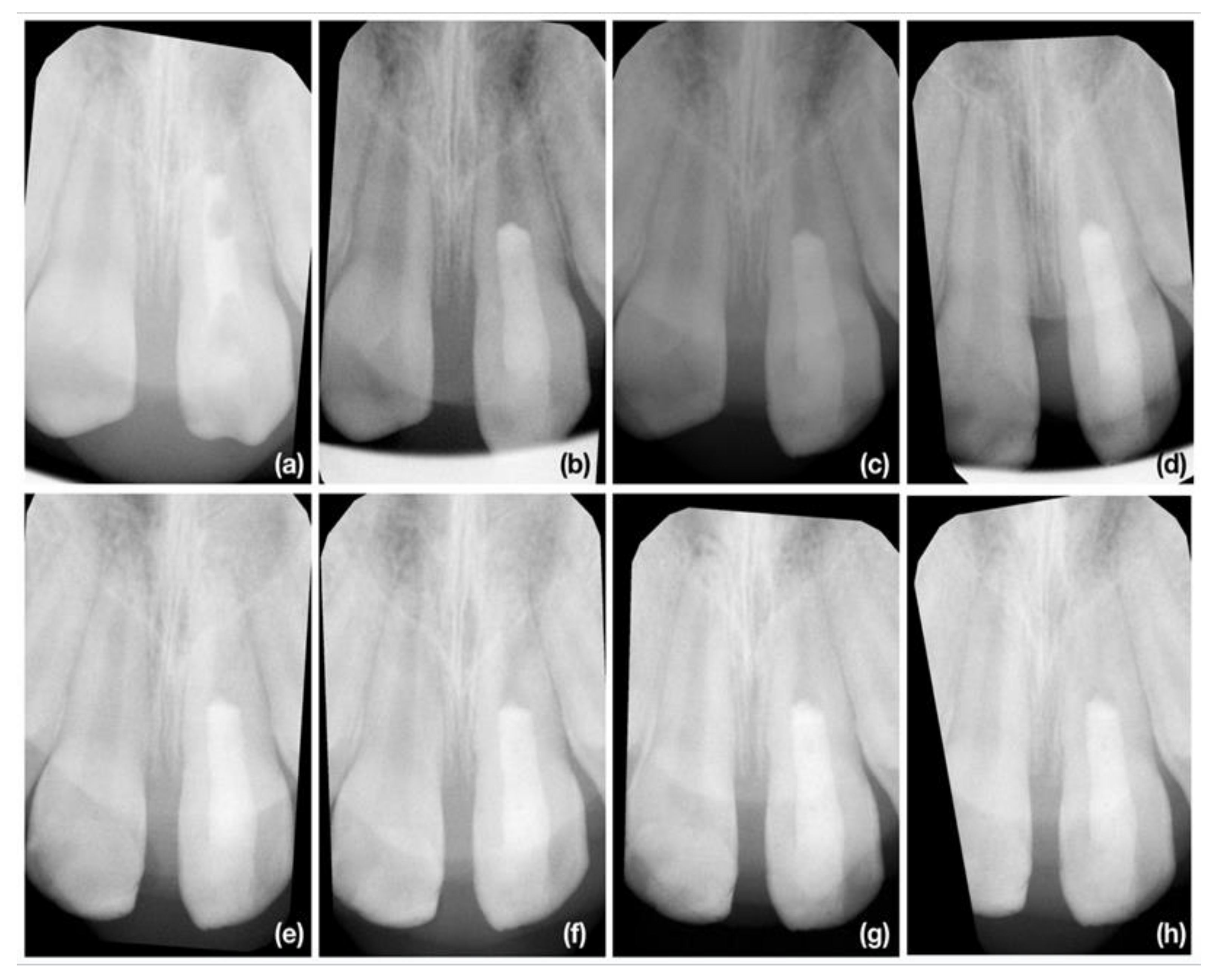 Jcm Free Full Text Clinical And Radiographic Outcomes Of Immature Teeth Treated With 