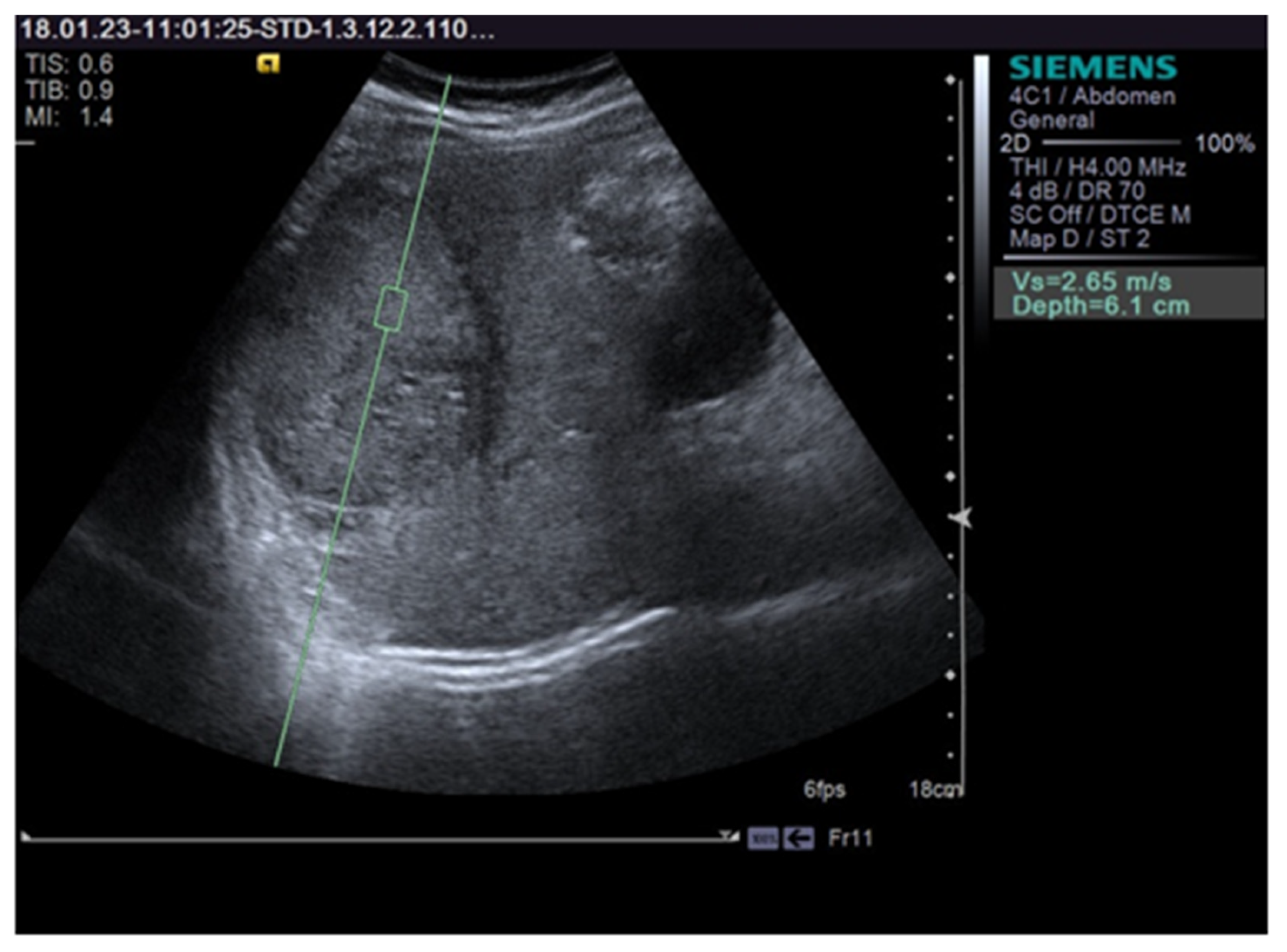 JCM | Free Full-Text | Is There a Place for Elastography in the Diagnosis  of Hepatocellular Carcinoma?