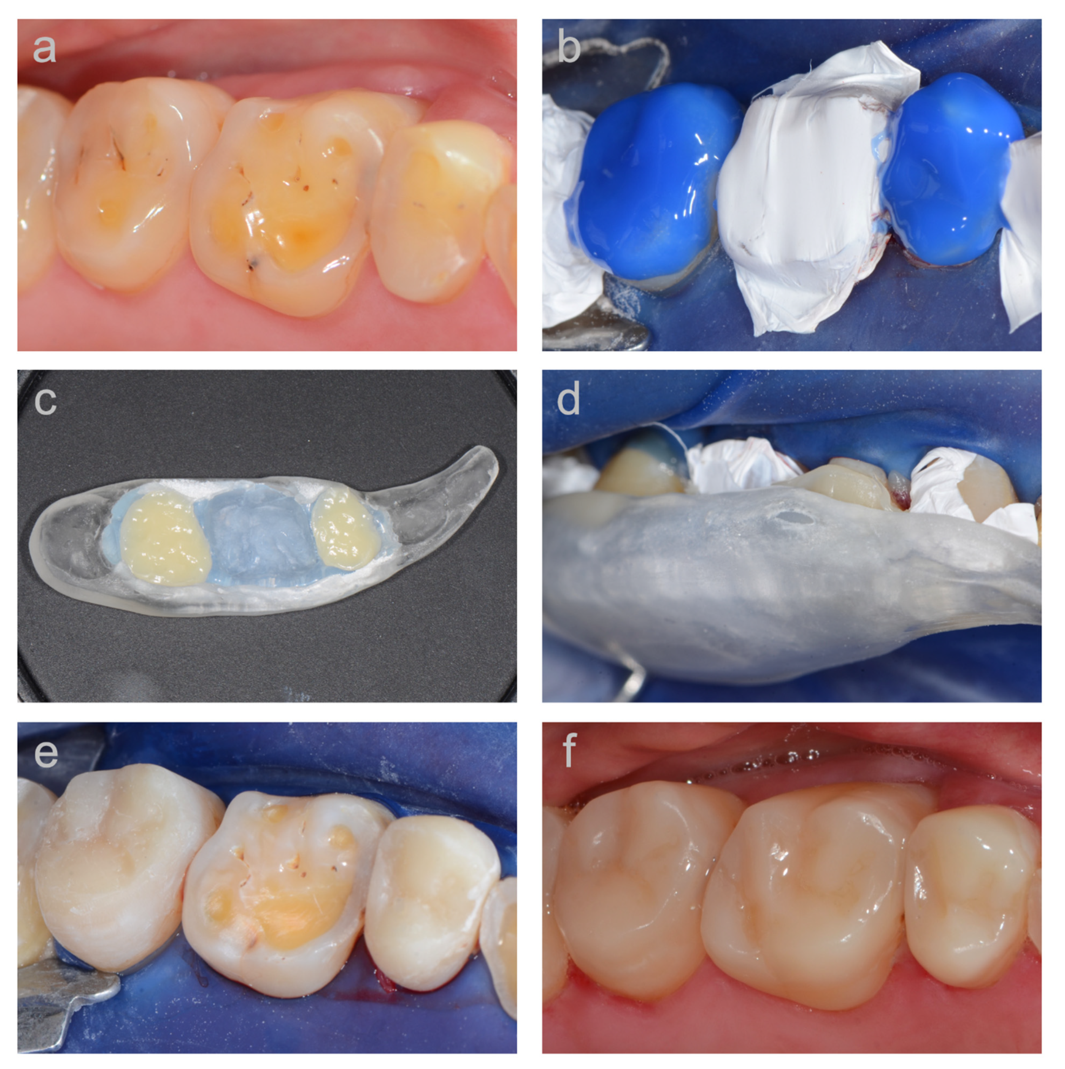JCM | Free Full-Text | Vertical Bite Rehabilitation of Severely Worn  Dentitions with Direct Composite Restorations: Clinical Performance up to  11 Years | HTML