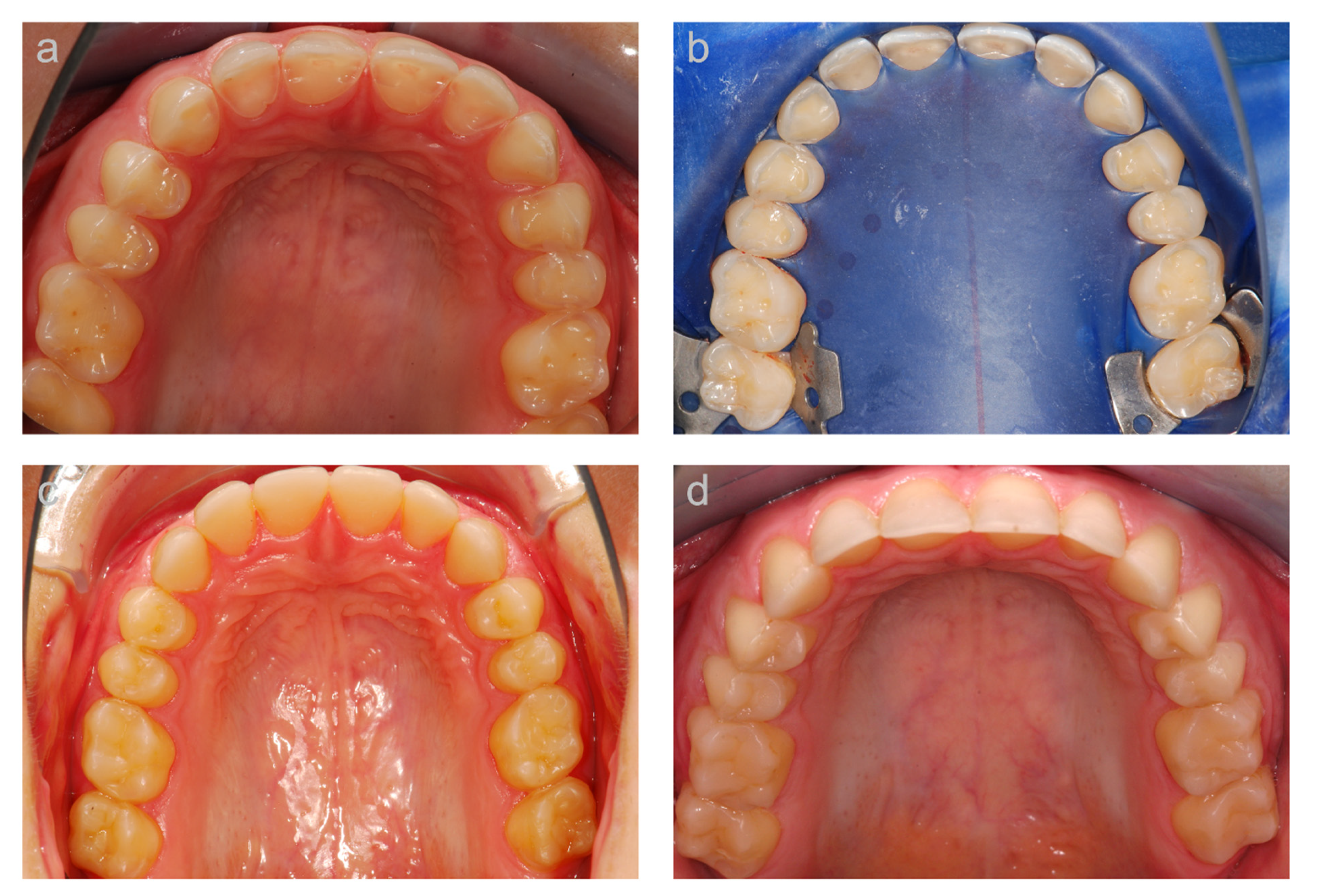 JCM | Free Full-Text | Vertical Bite Rehabilitation of Severely Worn  Dentitions with Direct Composite Restorations: Clinical Performance up to  11 Years | HTML
