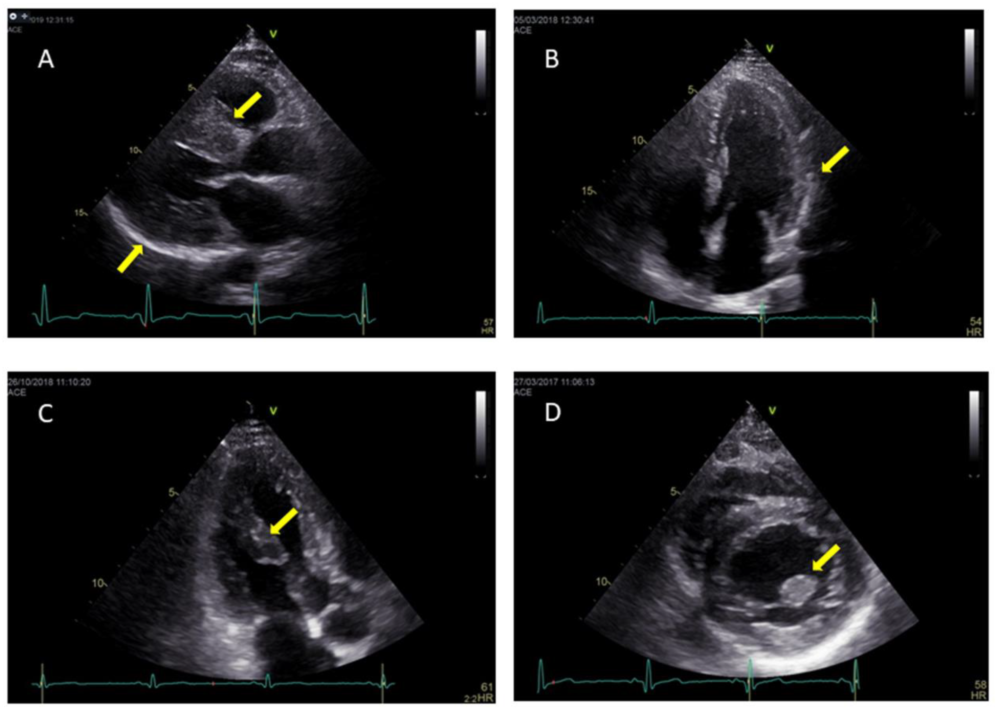 Echocardiography in Anderson-Fabry Disease