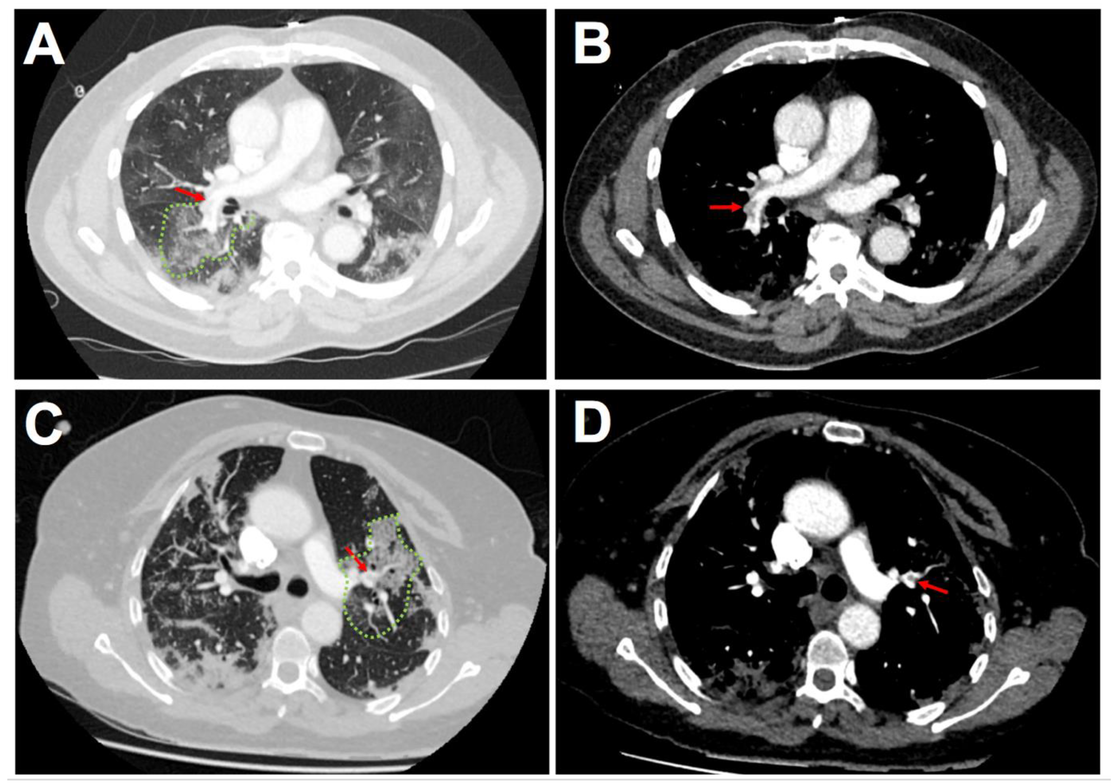 JCM | Free Full-Text | Acute Pulmonary Embolism in Patients with