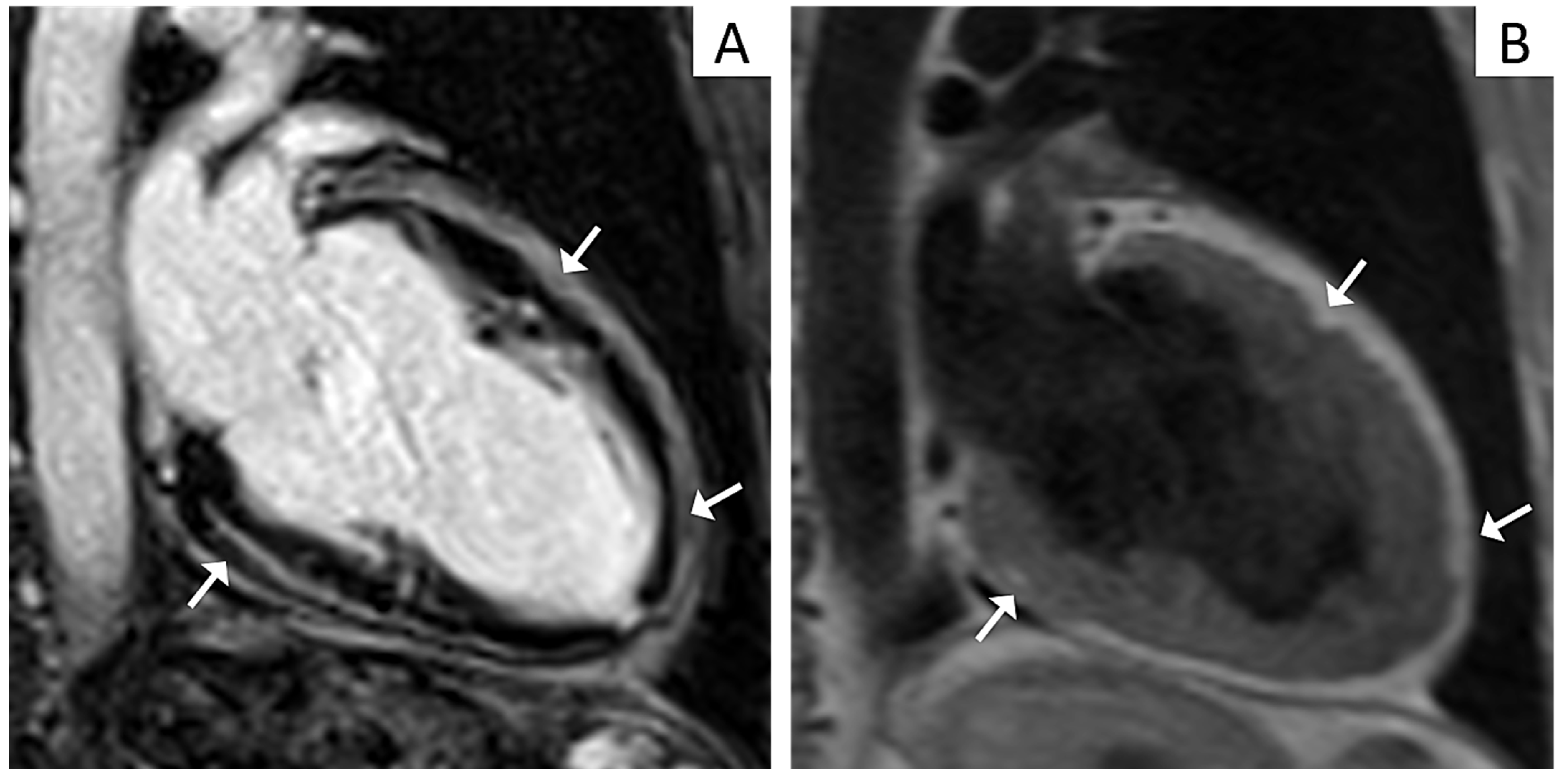 Left Ventricular Dysfunction in Arrhythmogenic Cardiomyopathy: Association  With Exercise Exposure, Genetic Basis, and Prognosis