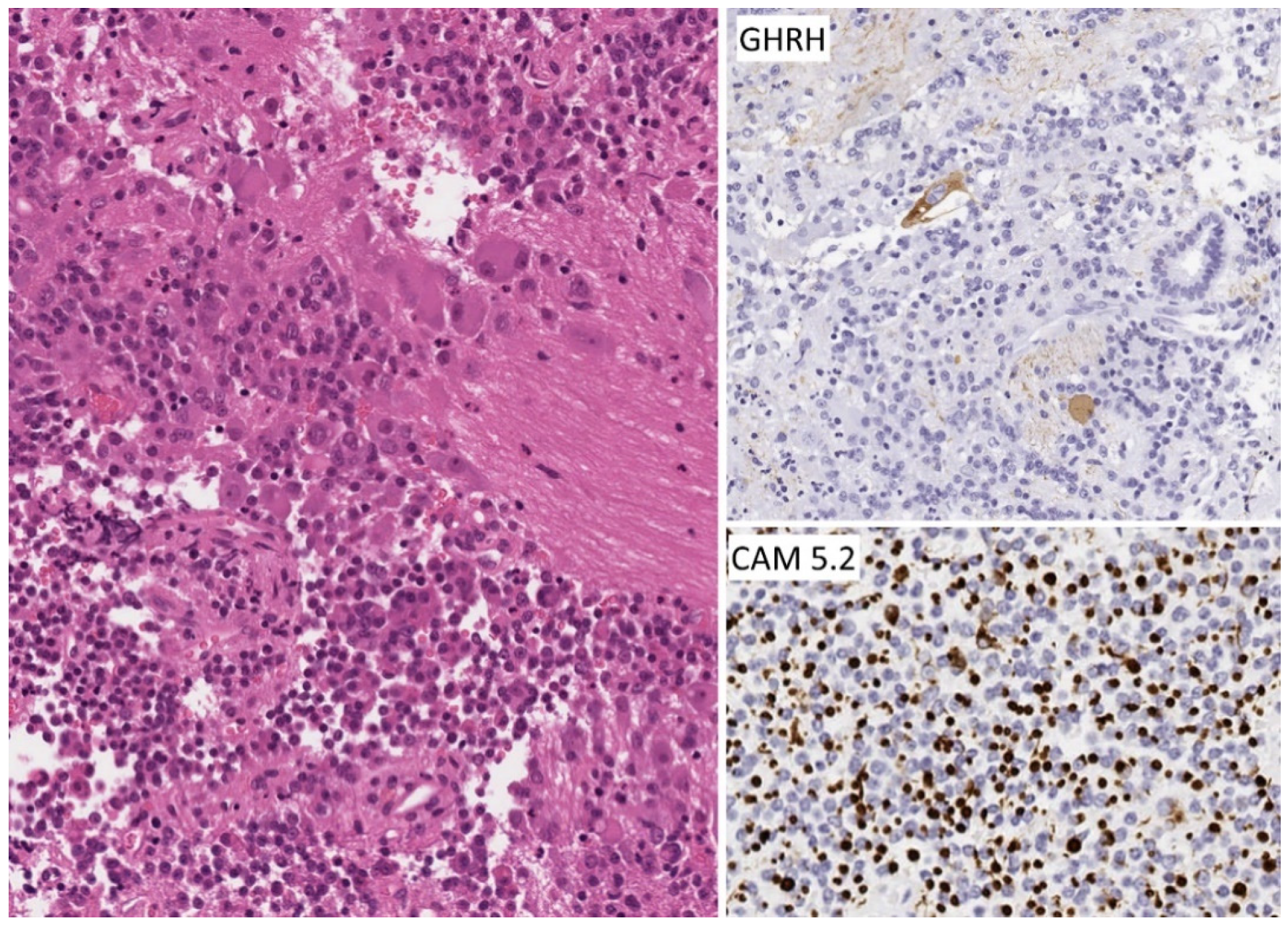 JCM | Free Full-Text | An Update on Pituitary Neuroendocrine Tumors Leading  to Acromegaly and Gigantism