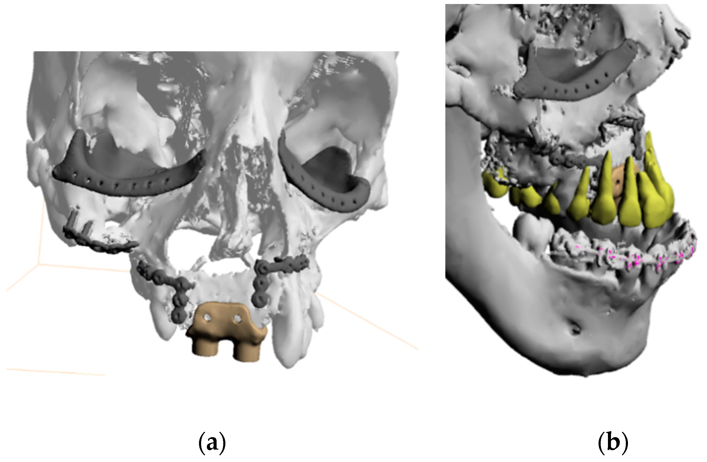 JCM | Free Full-Text | Protocol and Evaluation of 3D-Planned 