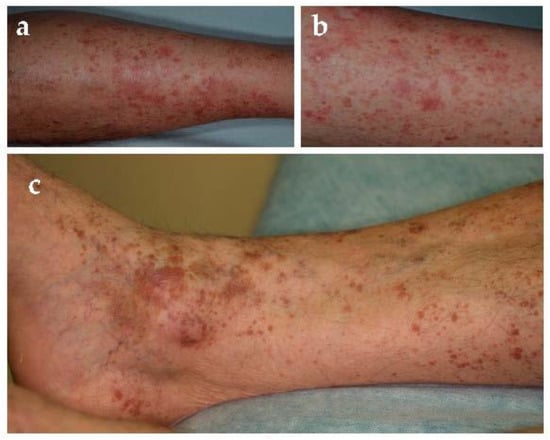Jcm Free Full Text Pigmented Purpuric Dermatoses A Complete