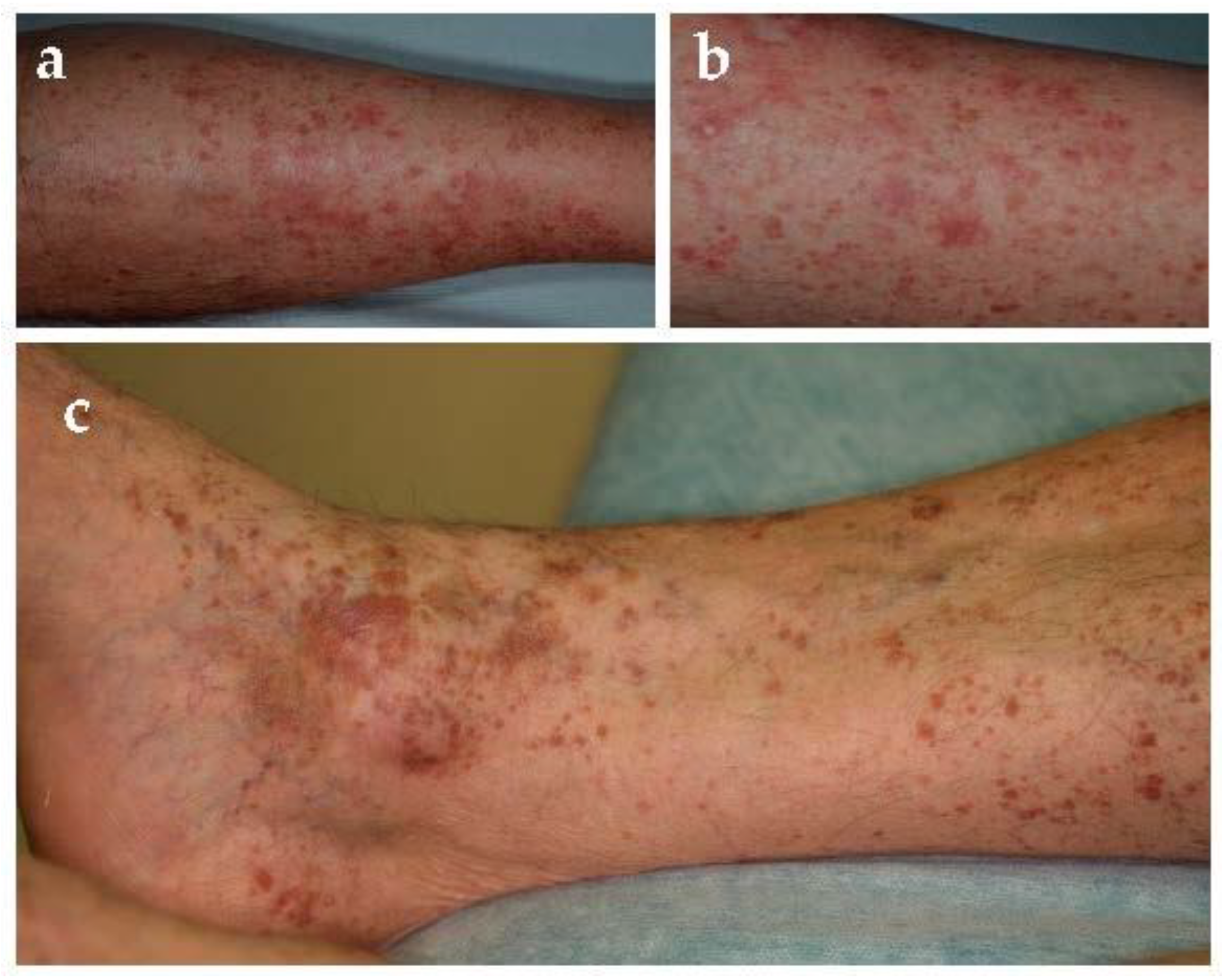 Jcm Free Full Text Pigmented Purpuric Dermatoses A Complete Narrative Review Html