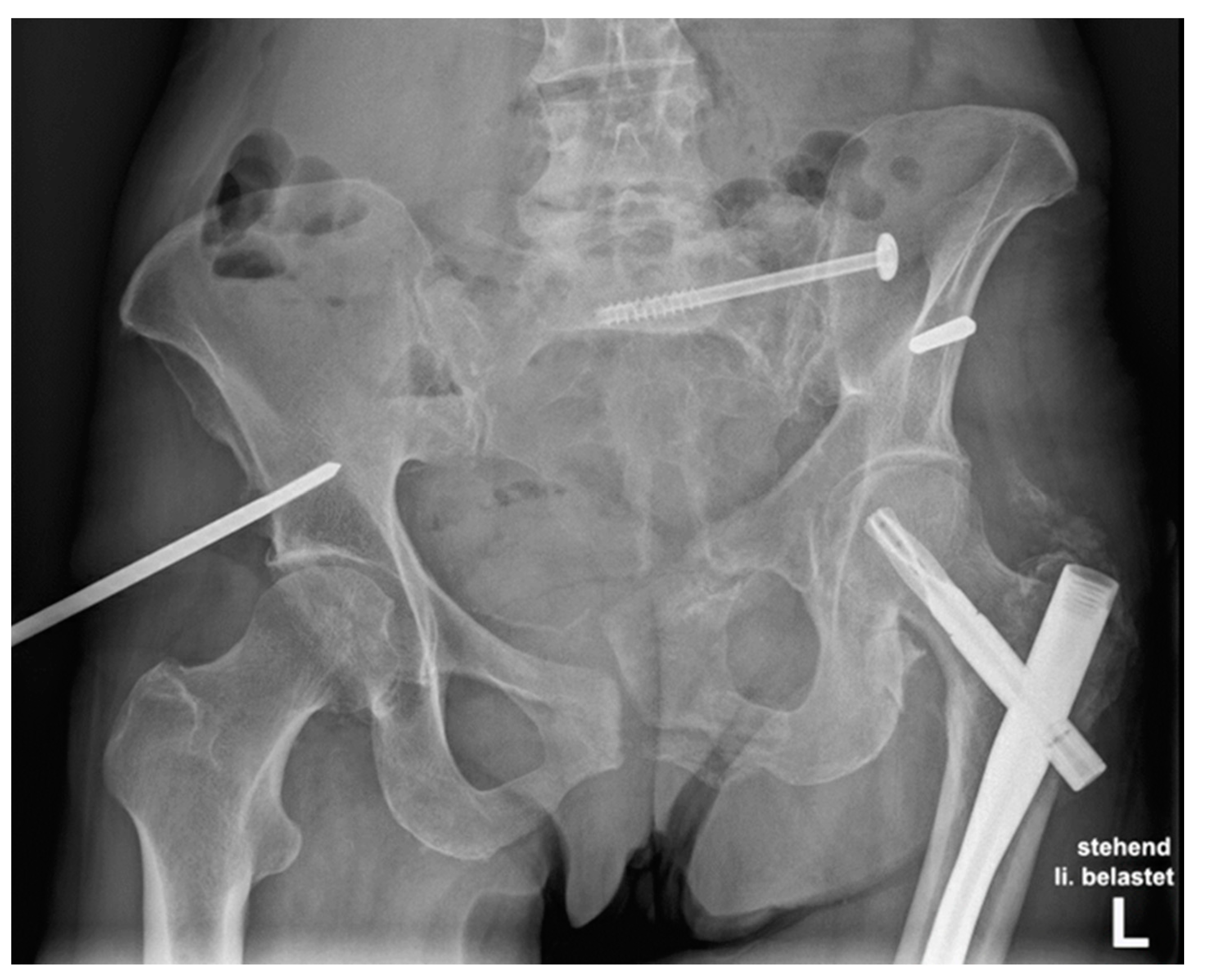 JCM | Free Full-Text | Biomechanical Comparison of Five Fixation Techniques  for Unstable Fragility Fractures of the Pelvic Ring