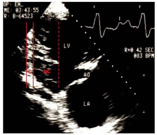 Left ventricular noncompaction: A rare indication for pediatric heart  transplantation